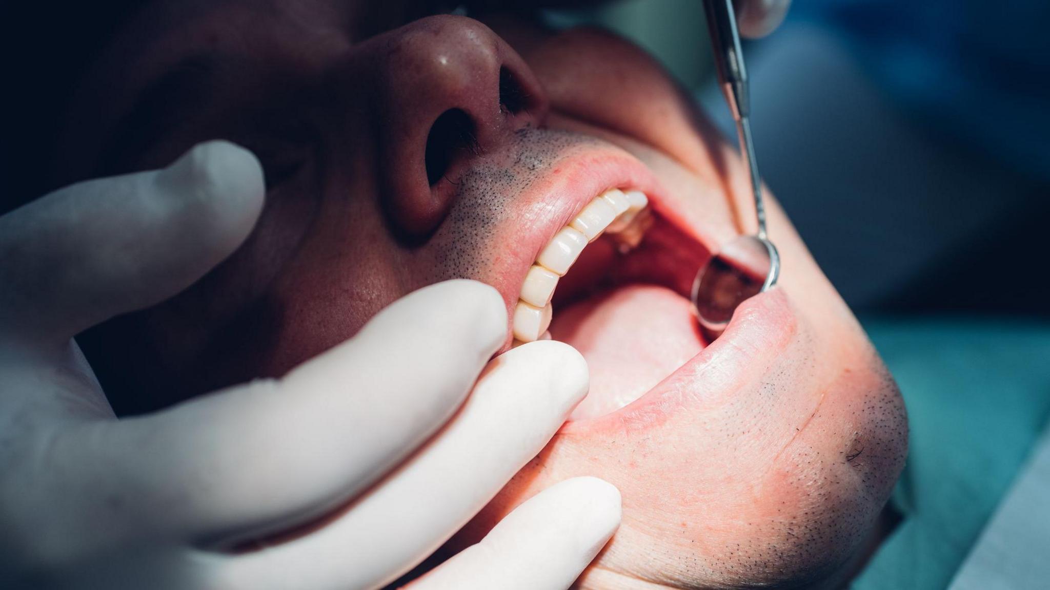 Close-up of a man having his teeth examined by a dentist who is wearing white latex gloves and looking in his mouth using a dental mirror.