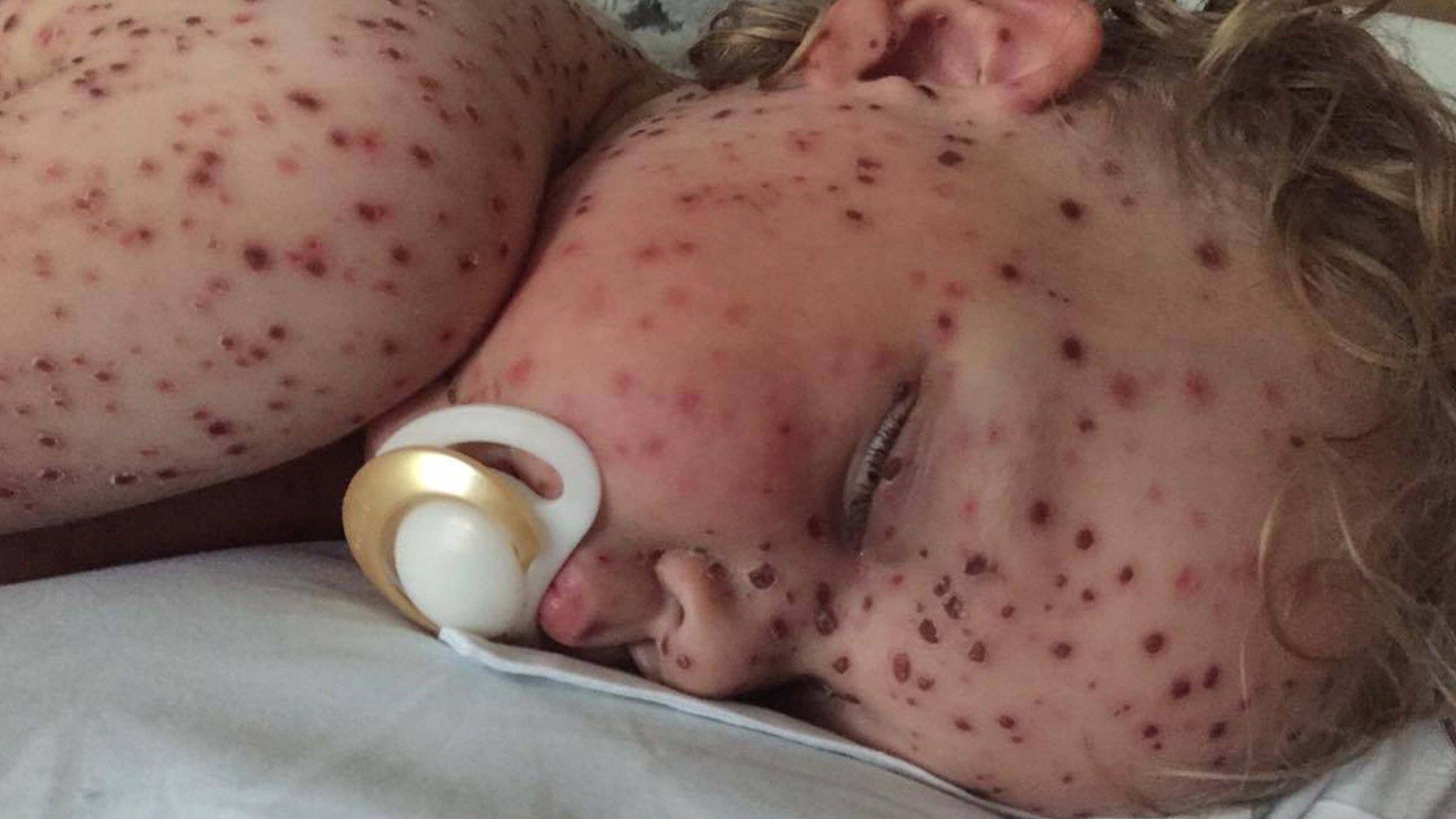 Chickenpox child