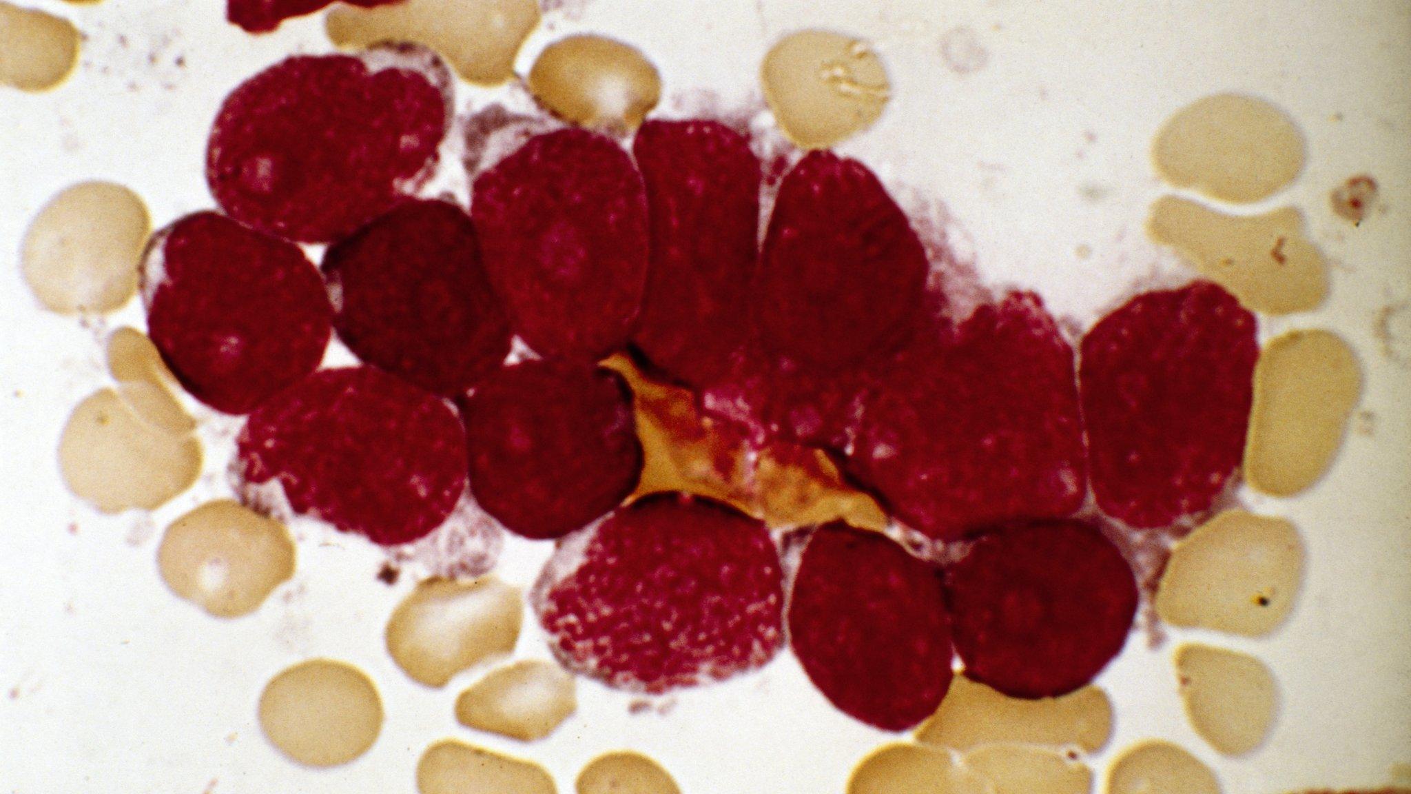 Leukaemia