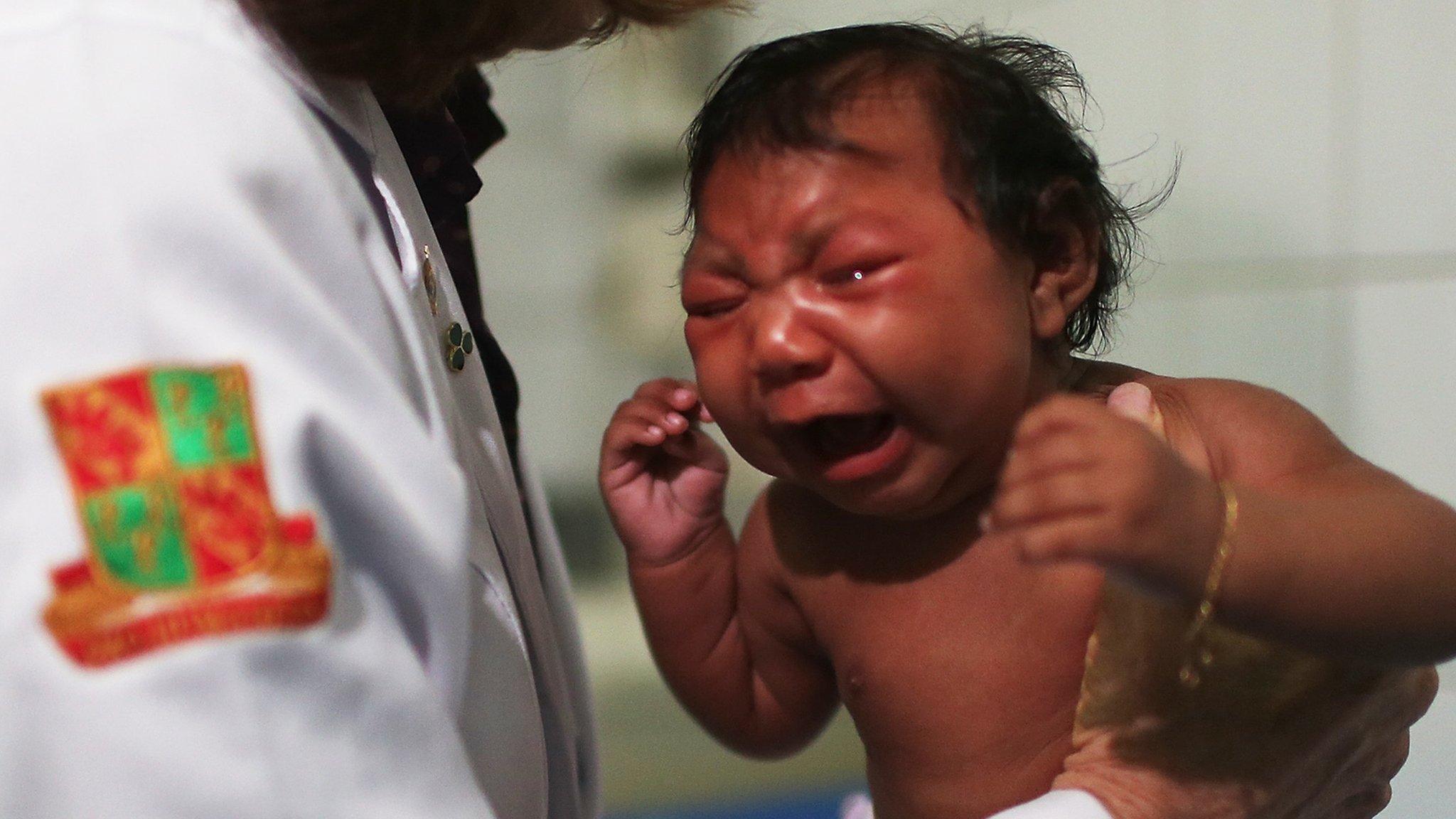 Baby with Zika virus