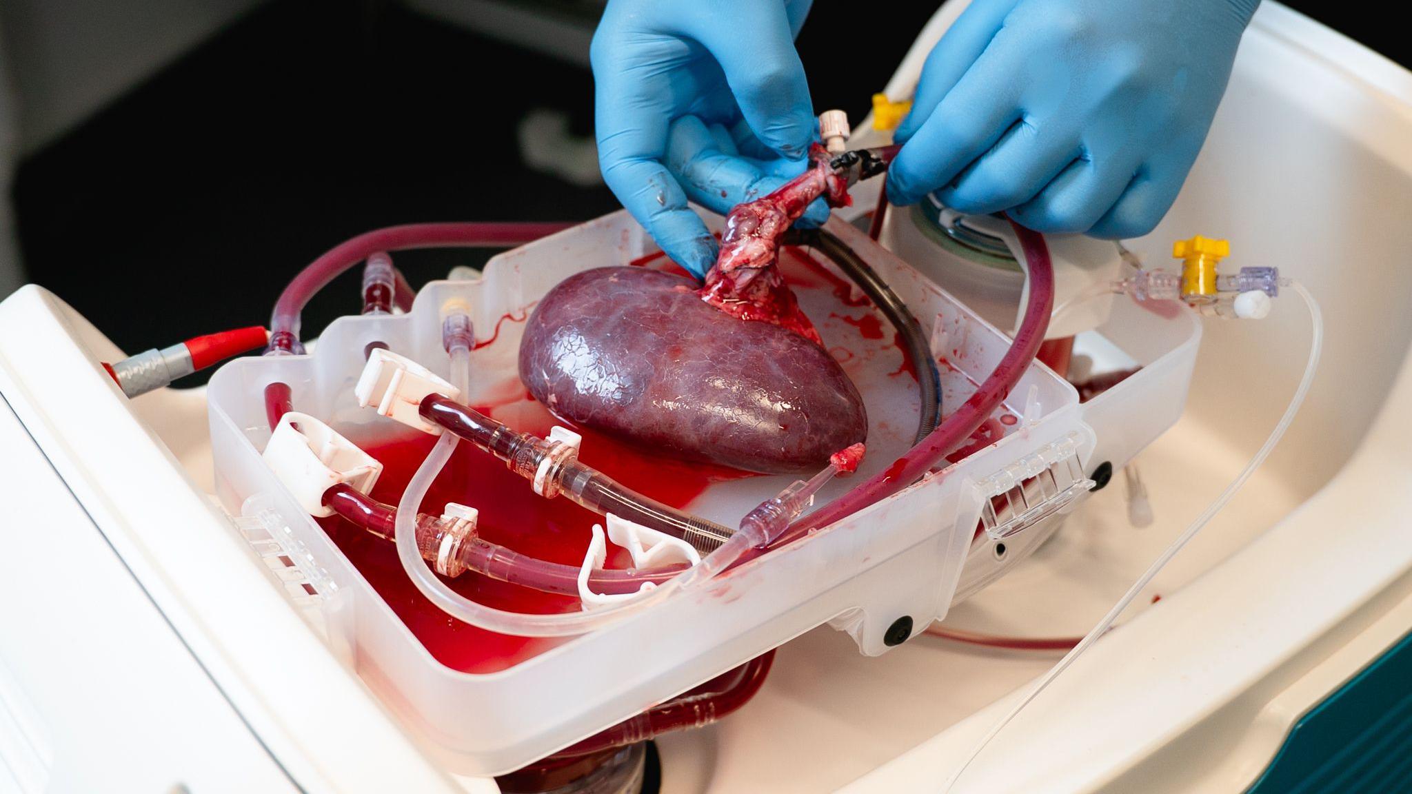 A person in blue latex gloves working on a liver hooked onto the OrganOx machine.