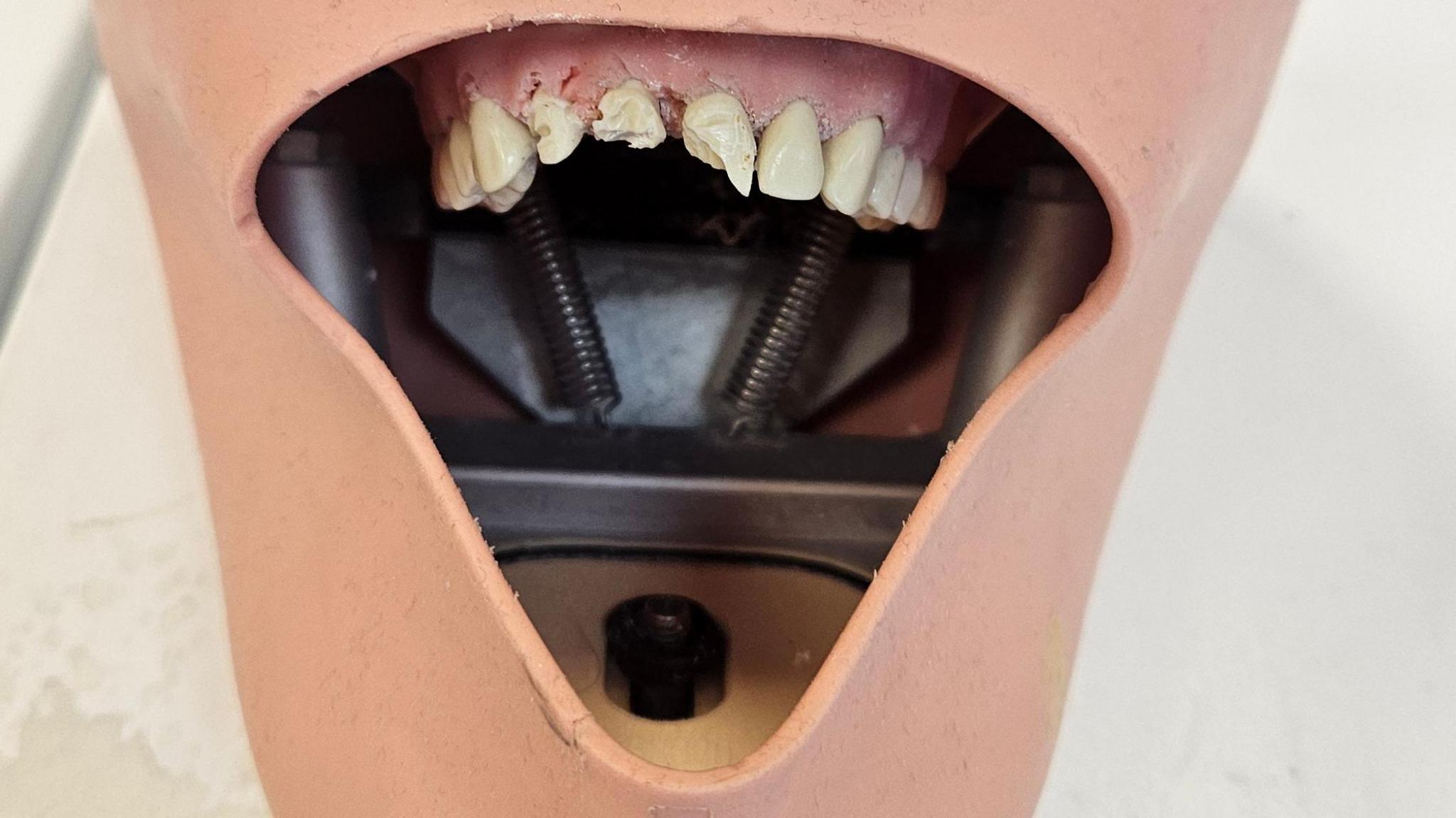 Mouth model shows decayed from three teeth inside a mouth containing springs