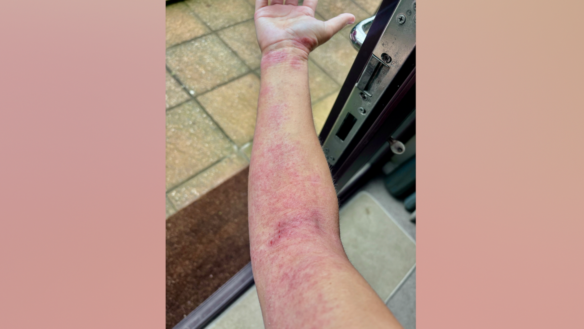 Elsie-May is holding out her arm and has taken a photo of it. There's a large red pathc in the middle of her arm and the skin is thin and sore. It has also been broken where it has been scratched.