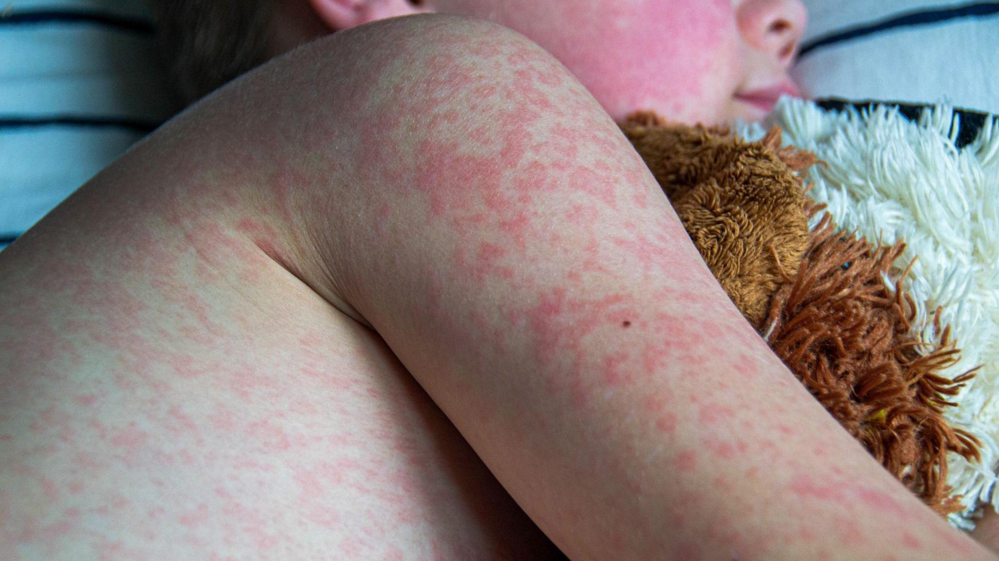 side profile of a child hugging a cuddly animal. The child looks like he is sleeping, and he has blotchy red patches across his arm and body. There are so many of them on his face that they have joined together into one big red patch