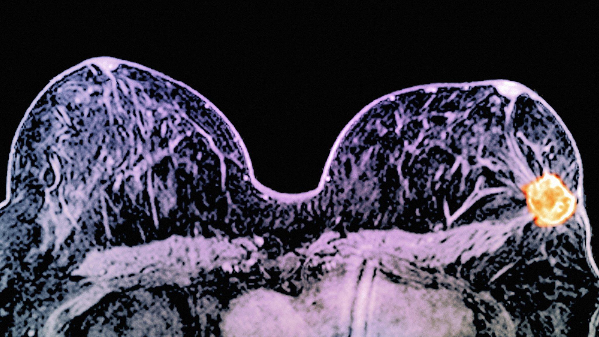 Breast cancer