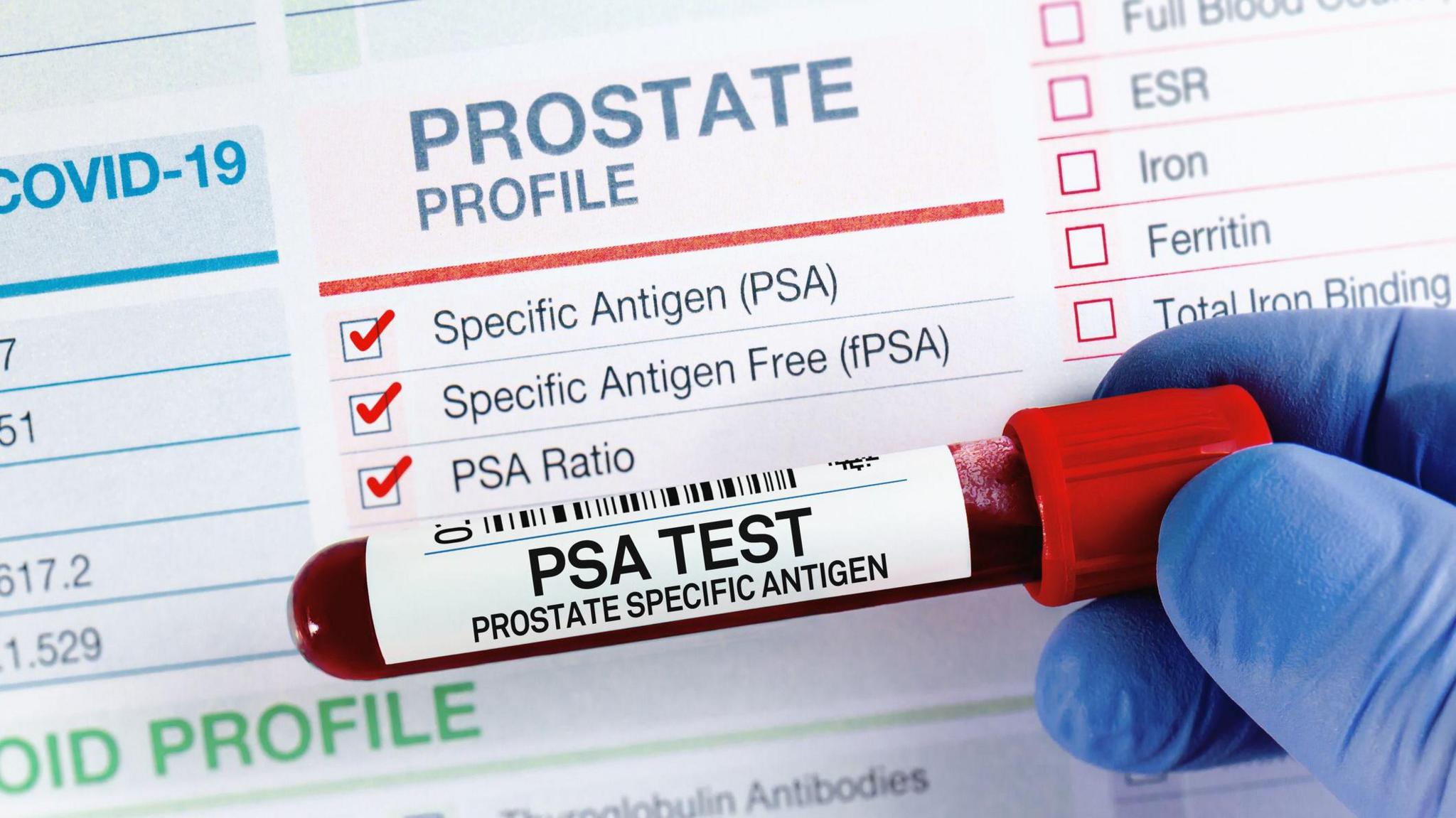 A sample of a man's blood to be tested for PSA is held by someone wearing blue gloves against a form featuring tick boxes