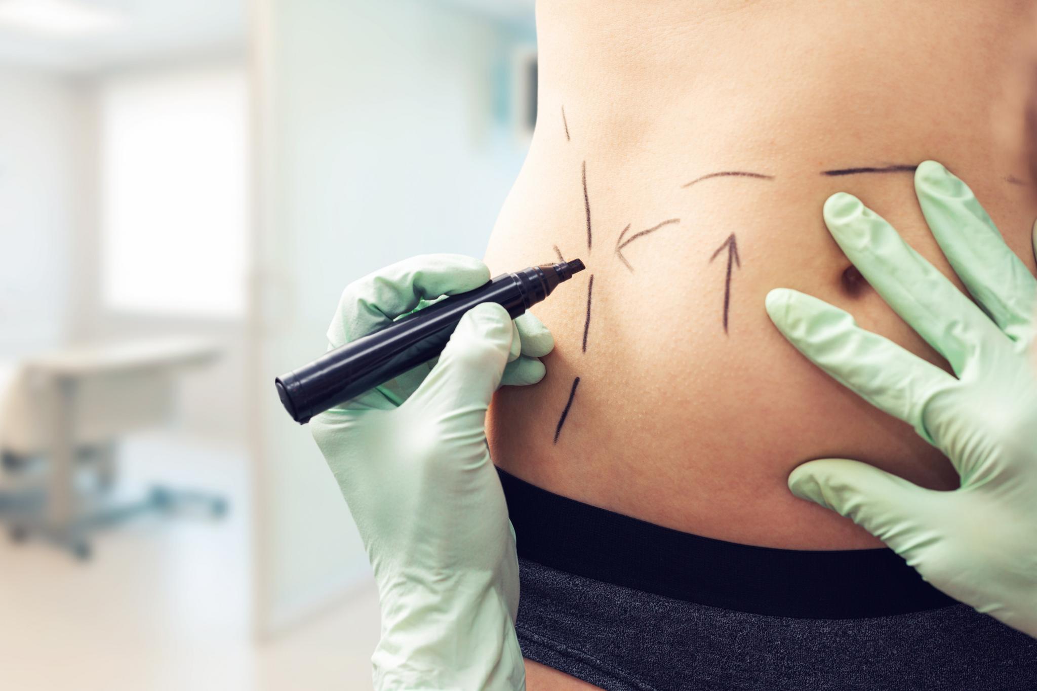 A patient is marked up for liposuction