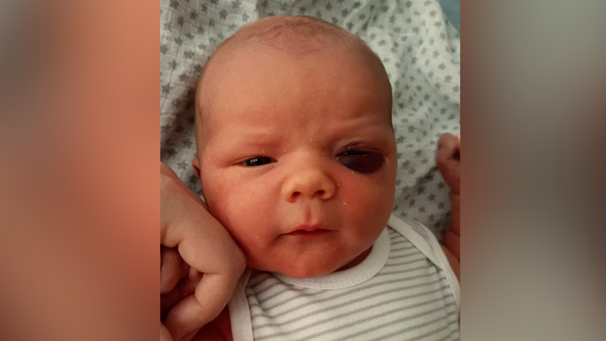 A baby wearing a white and grey striped top is being cared for shortly after being born. He has suffered from bruising to his eye as a result of the rare blood disorder he has inherited. 