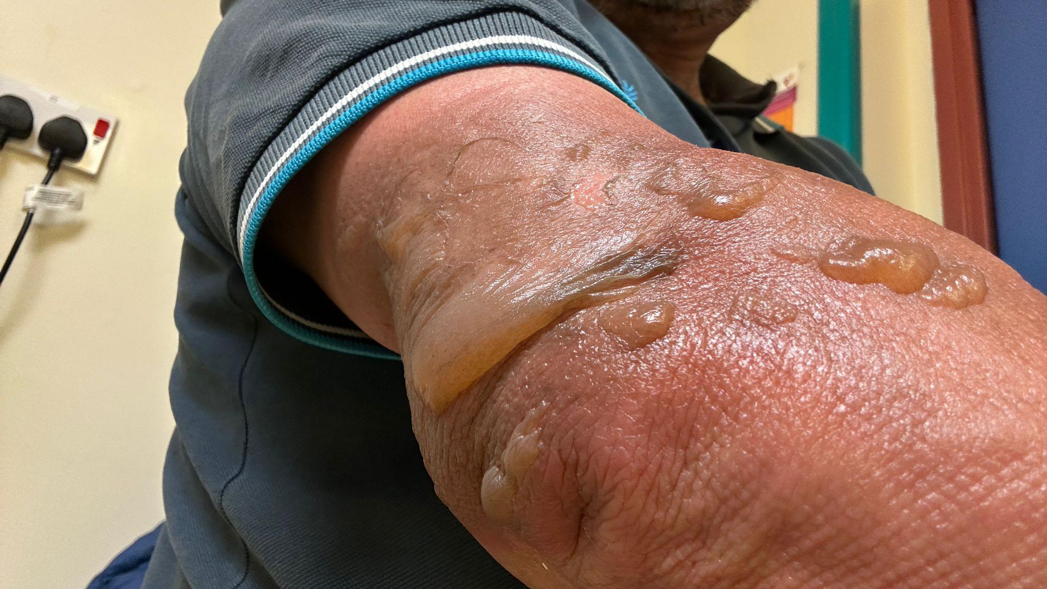 A burned and blistered back of the arm of a man in a dark blue polo shirt 