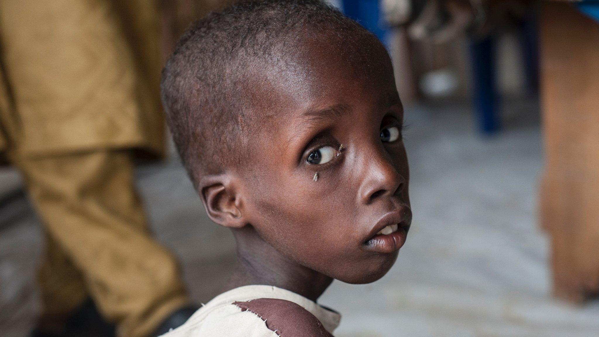 Boy suffering severe malnutrition at one of the Unicef nutrition clinics in Muna on outskirts of Maiduguri, capital of Borno State, north-eastern Nigeria. 30 June 2016