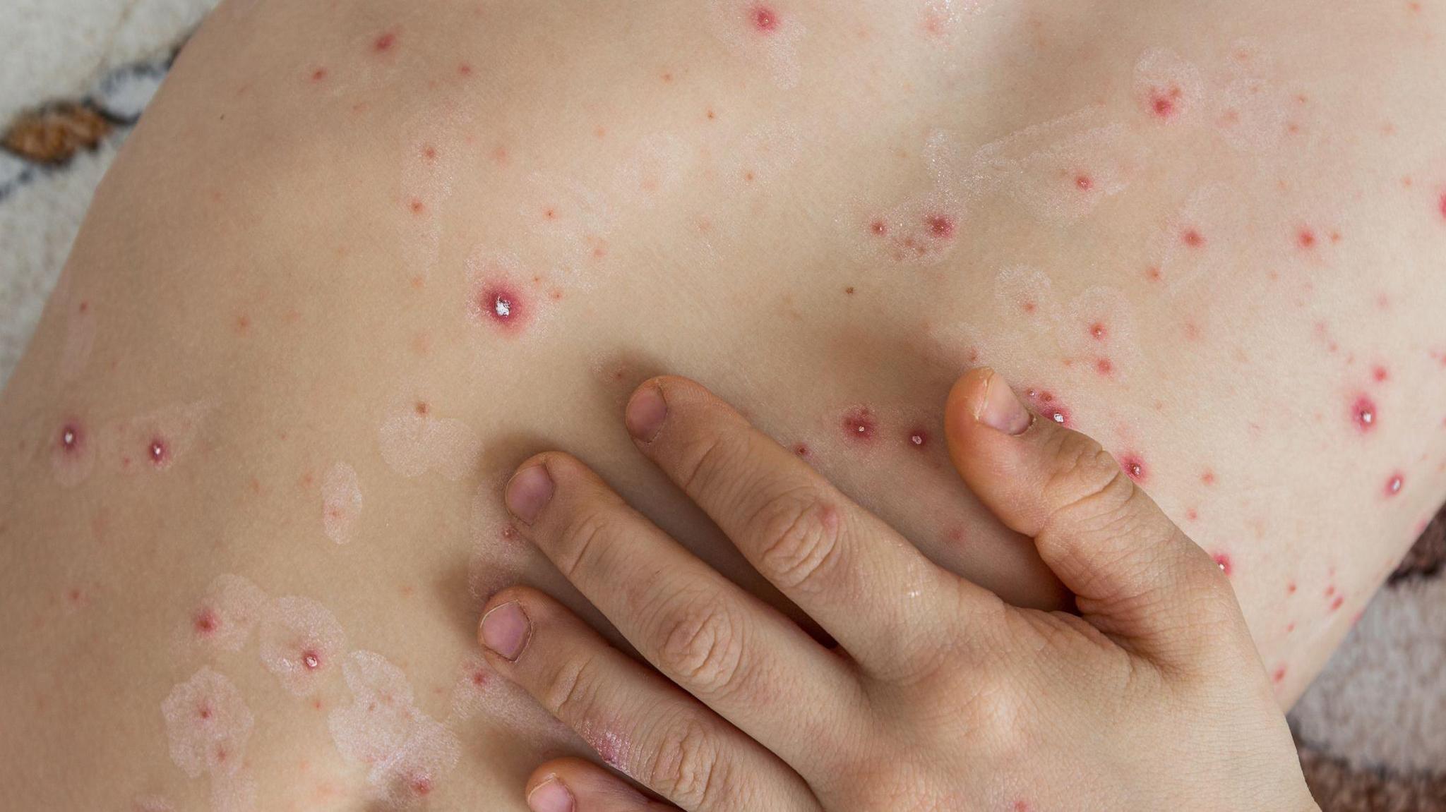 A child, lying on a rug, reveals their tummy rash that is red with some scabs