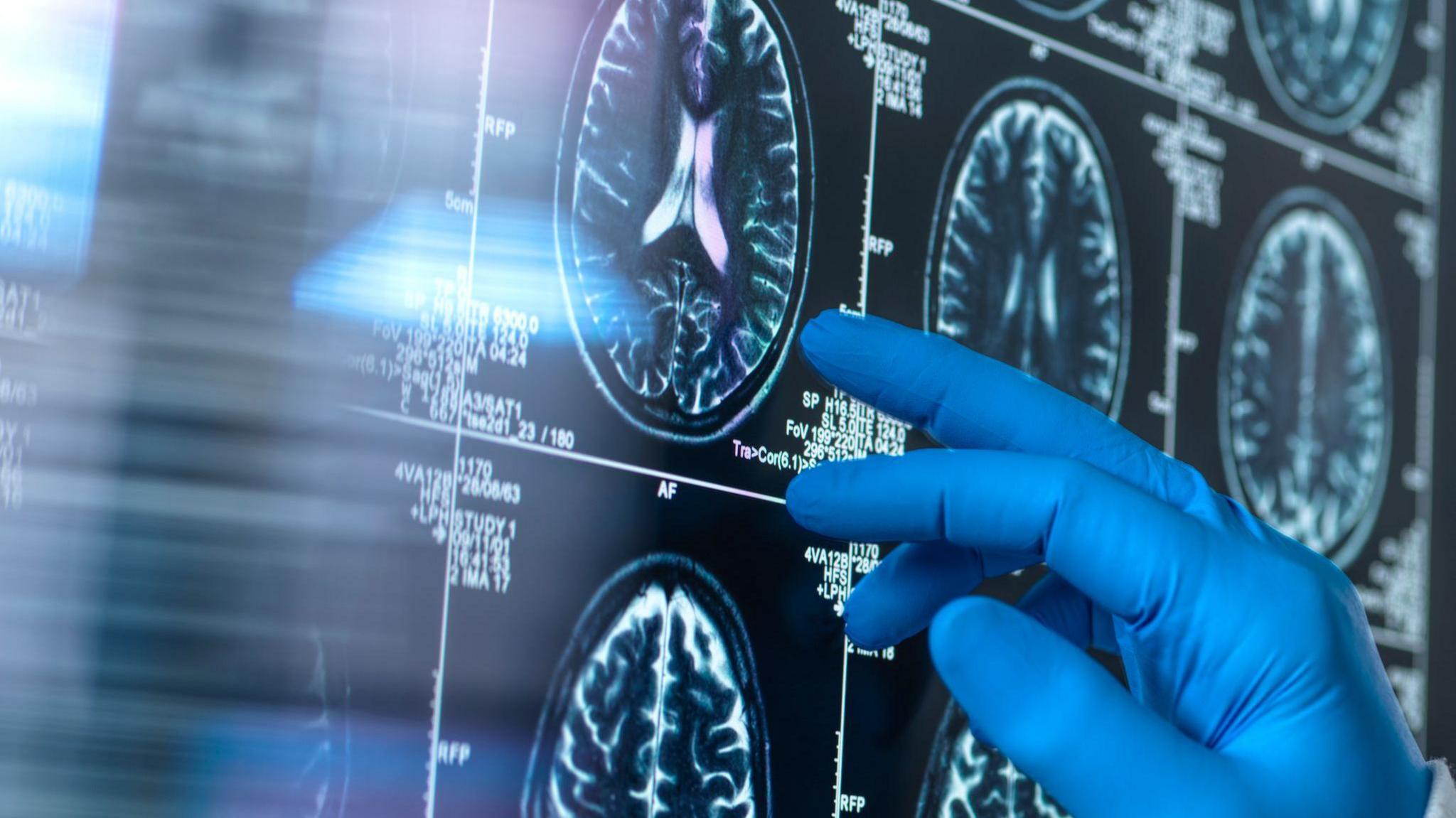 A stock image of a health professional's blue-gloved hand pointing out features on brain scans. 