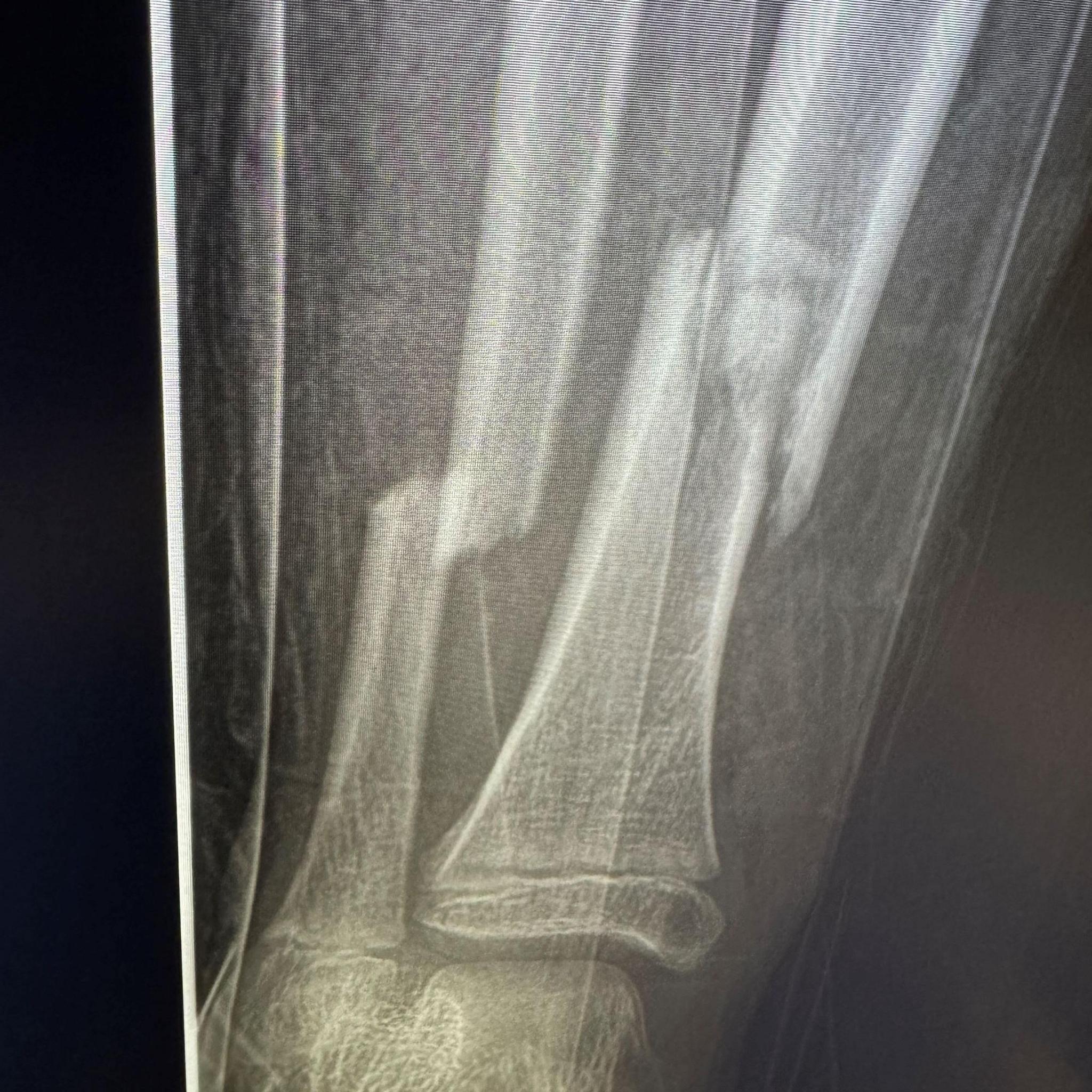 An x-ray image showing two broken bones