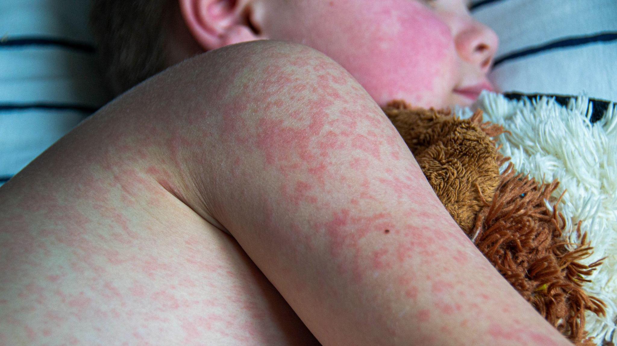 A young boy lying down, covered in a red rash, hugging a soft toy