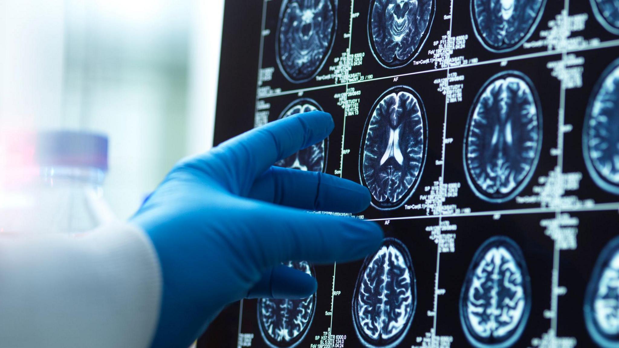 A stock image of a doctor looking at brain scan results on a screen. The full image is of rows of different views of the brain, and we see a white-sleeves arm and a hand in blue medical gloves pointing out one of the images