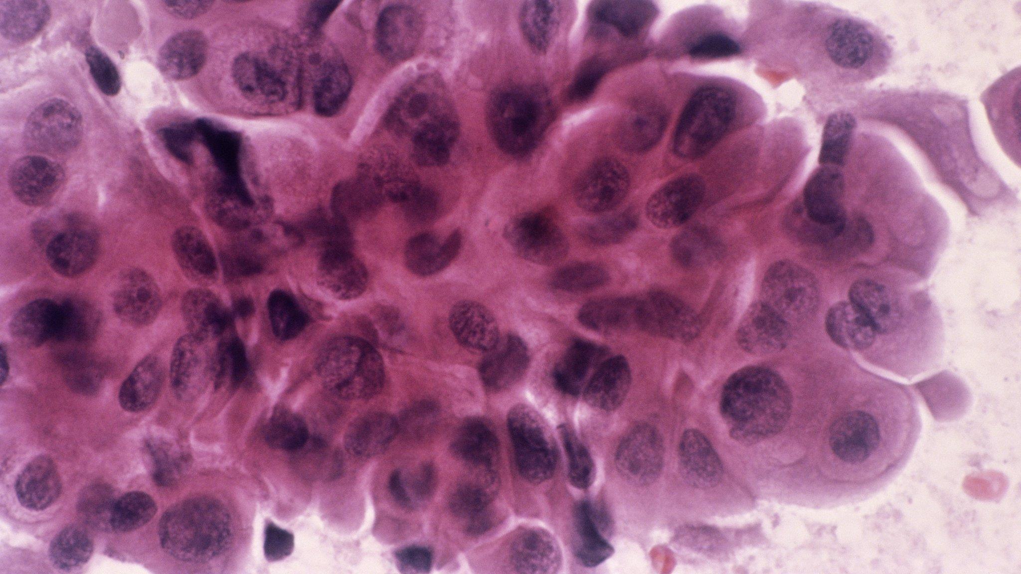 Breast cancer cells