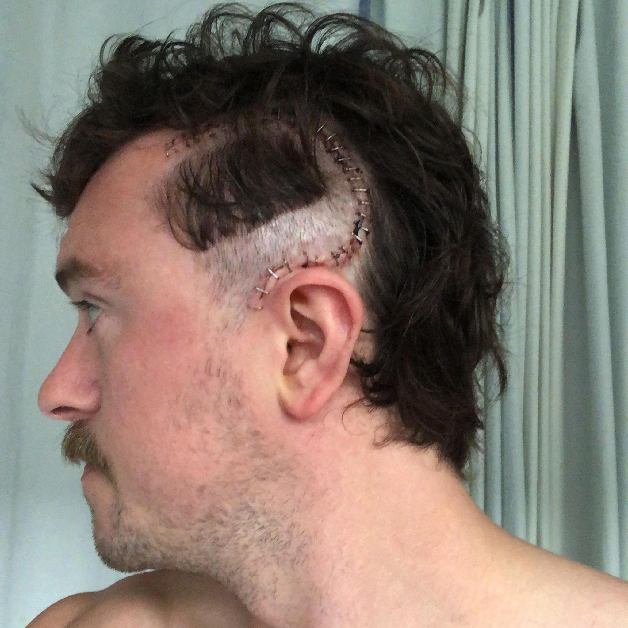 A man with short brown hair and a moustache is shown in profile, looking to the left. A large curved surgical scar with metal staples runs from above his ear across the side of his head. He is shirtless, with hospital curtains in the background.