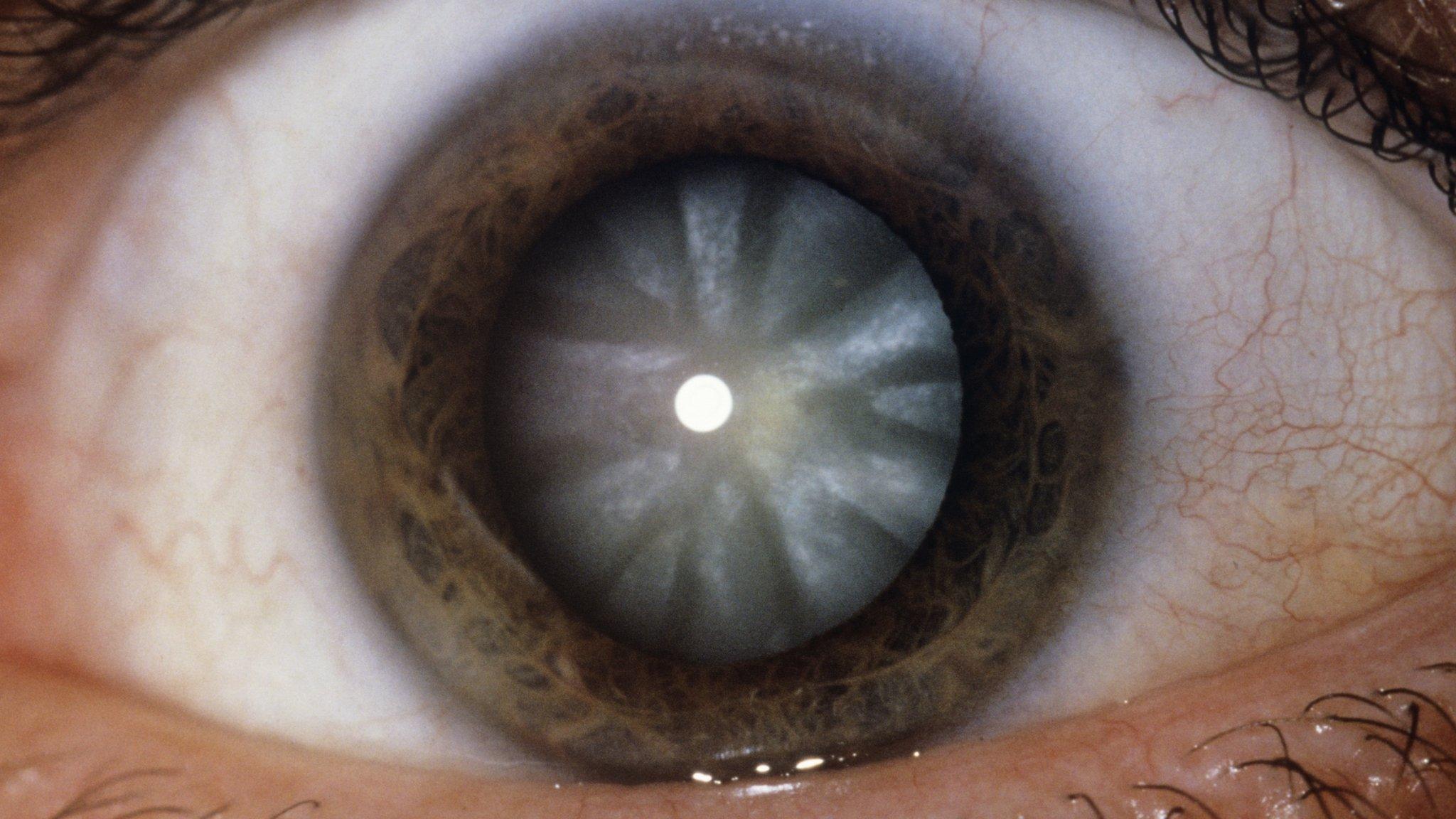 Eye with cataract