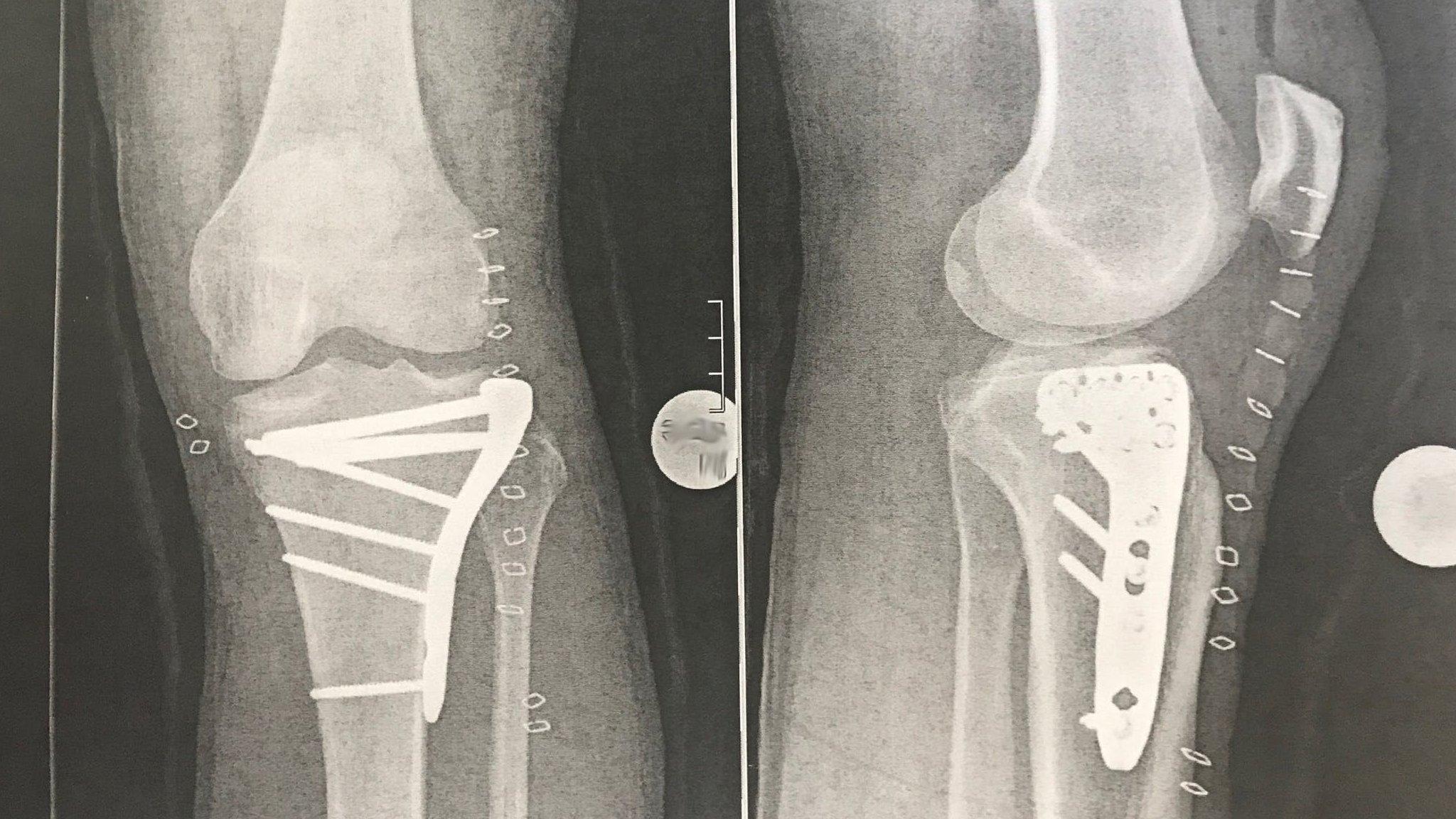 X-ray of Richard Hammond's leg