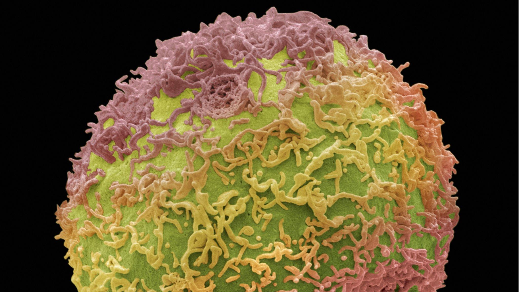 Prostate cancer cell