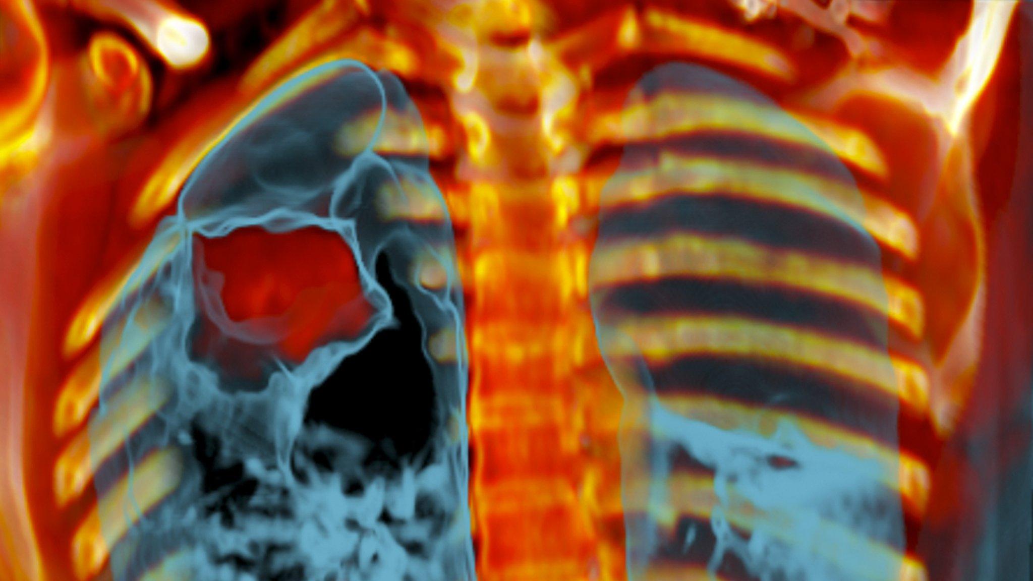 Lung cancer, CT scan