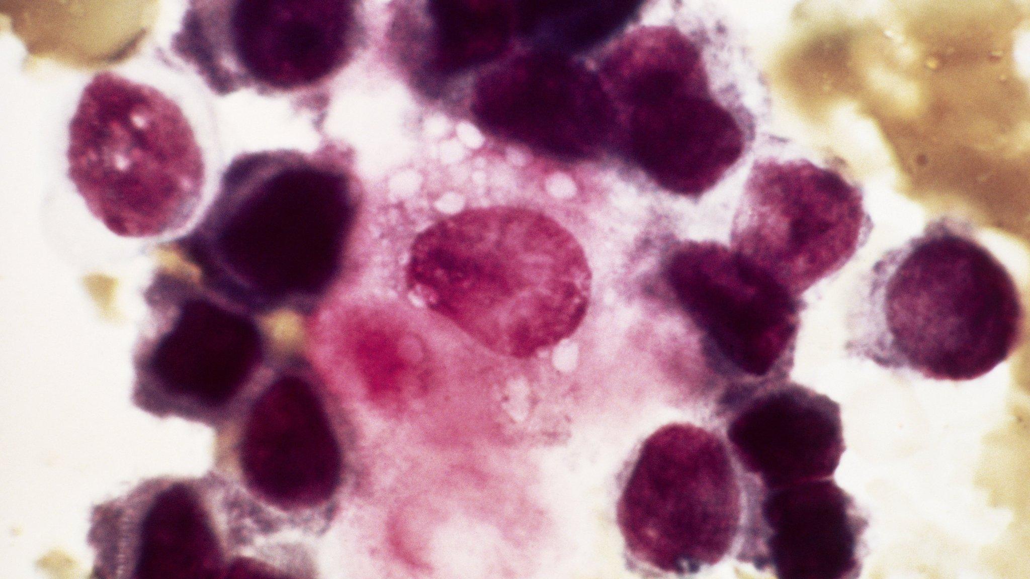 Secondary or metastatic breast cancer