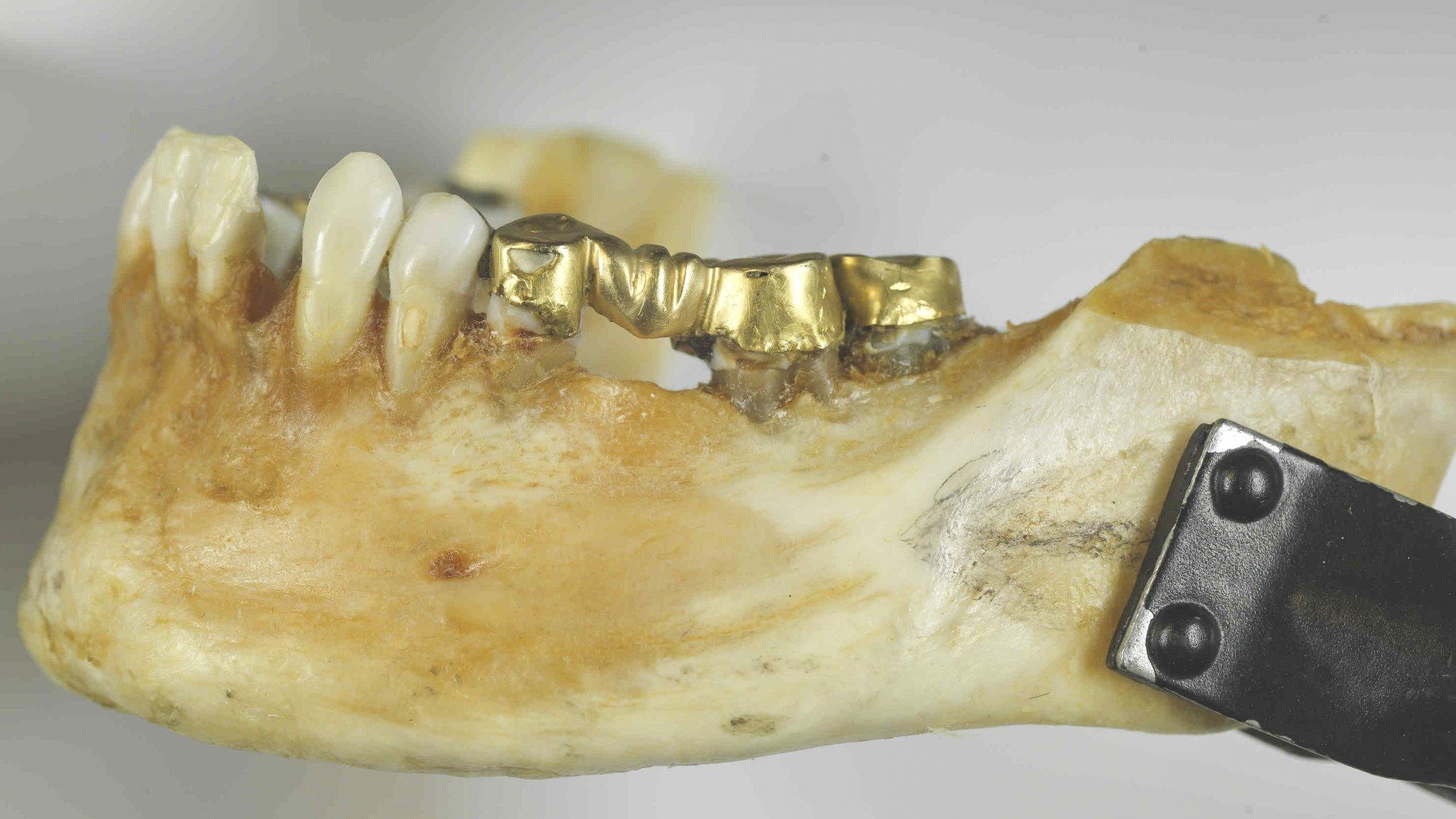 The Isdal Woman's lower jaw, courtesy of Norwegian police