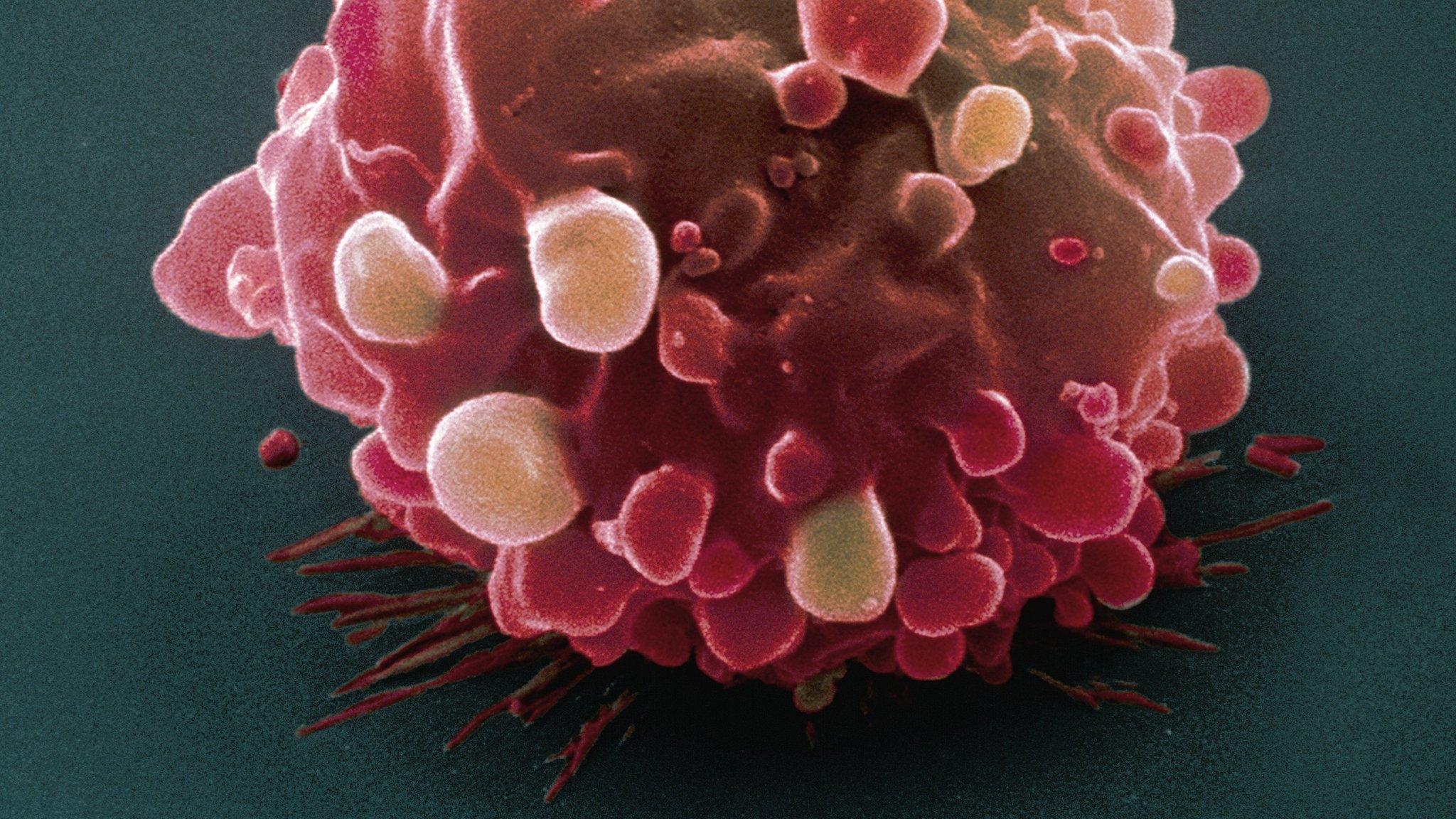 Bowel cancer cell