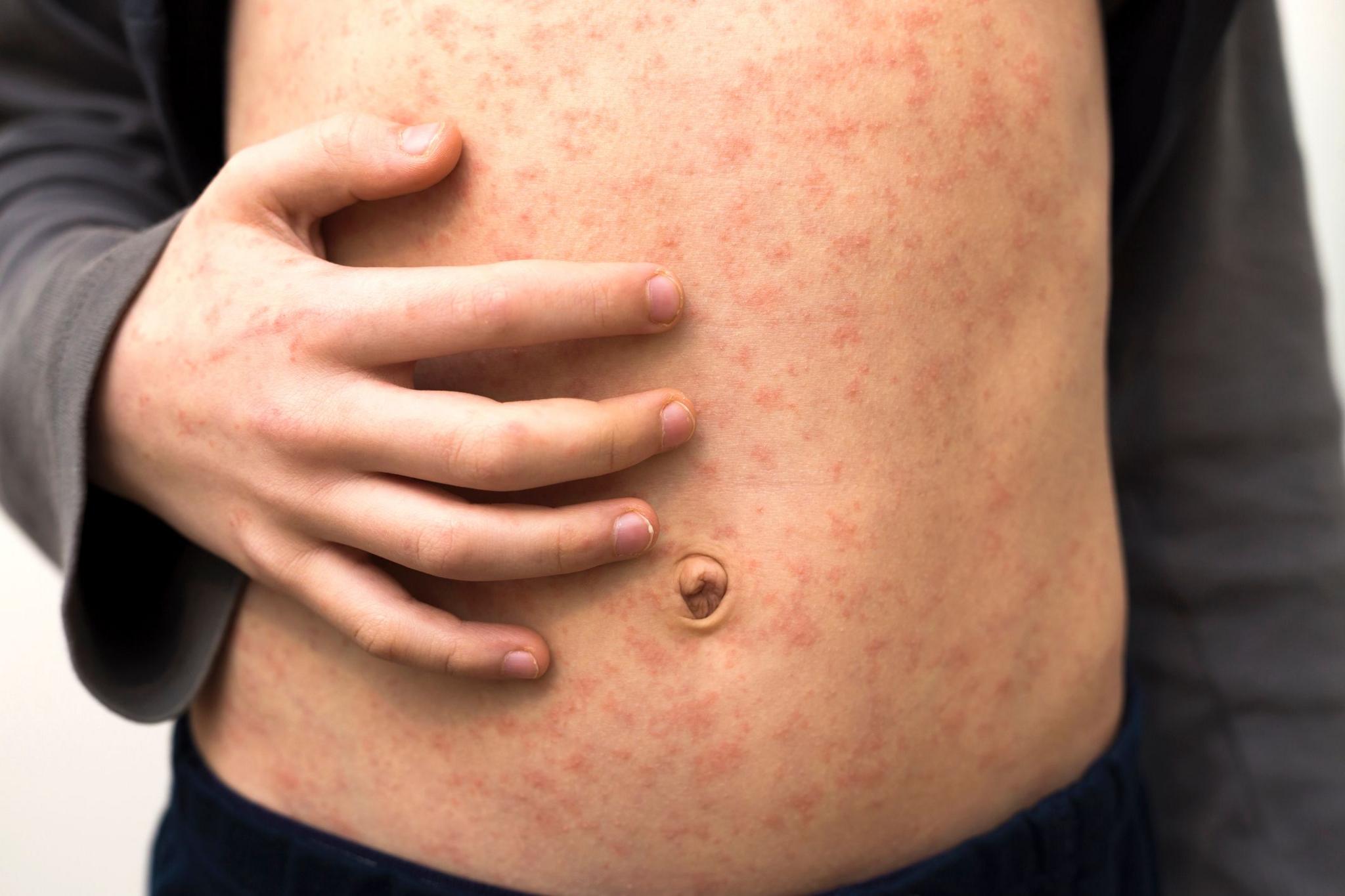 A person's stomach which has a measles rash all over it. They are holding their stomach with their right hand.