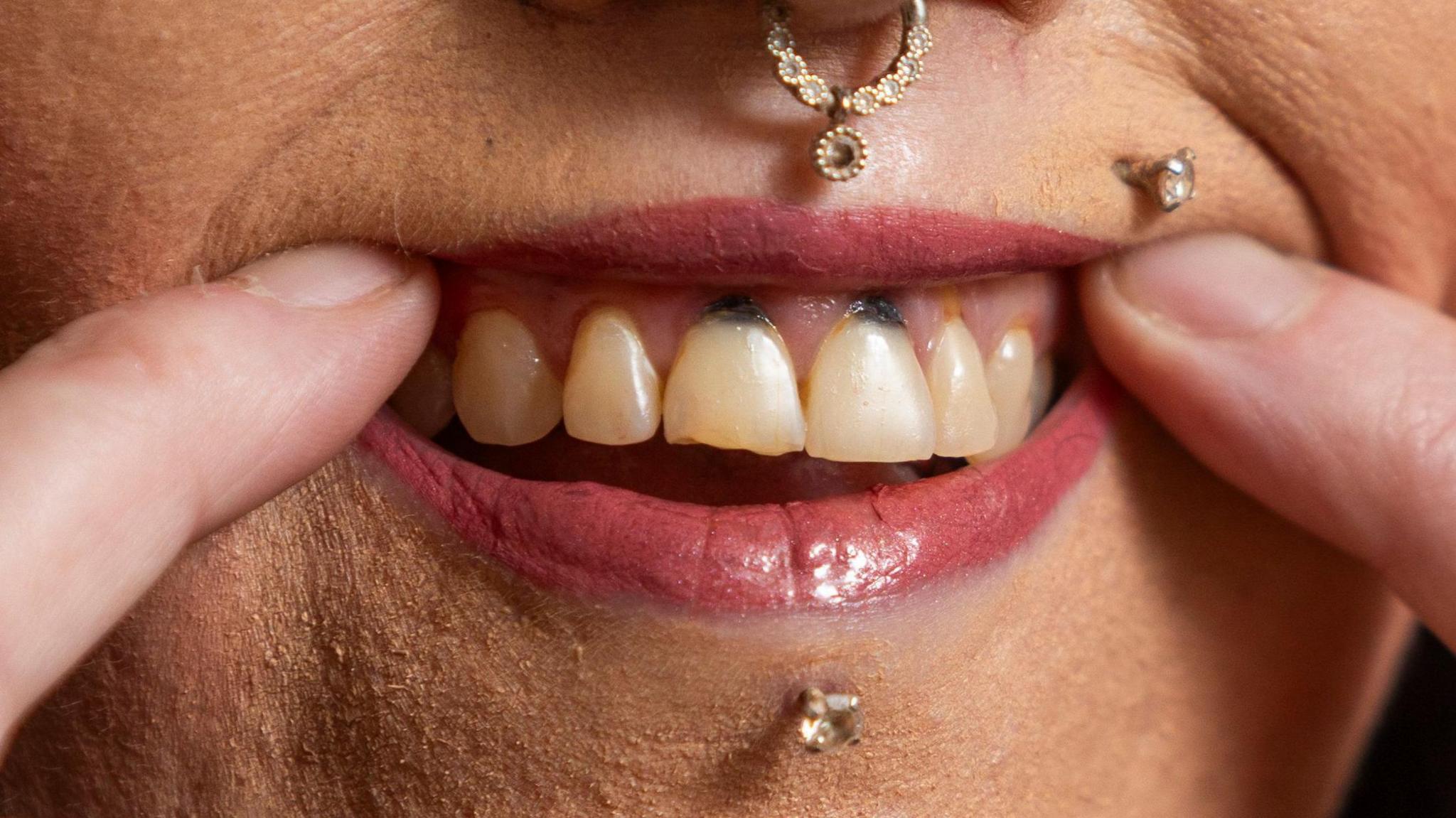 Vaping left black holes in my teeth, says Swansea ex dental nurse
