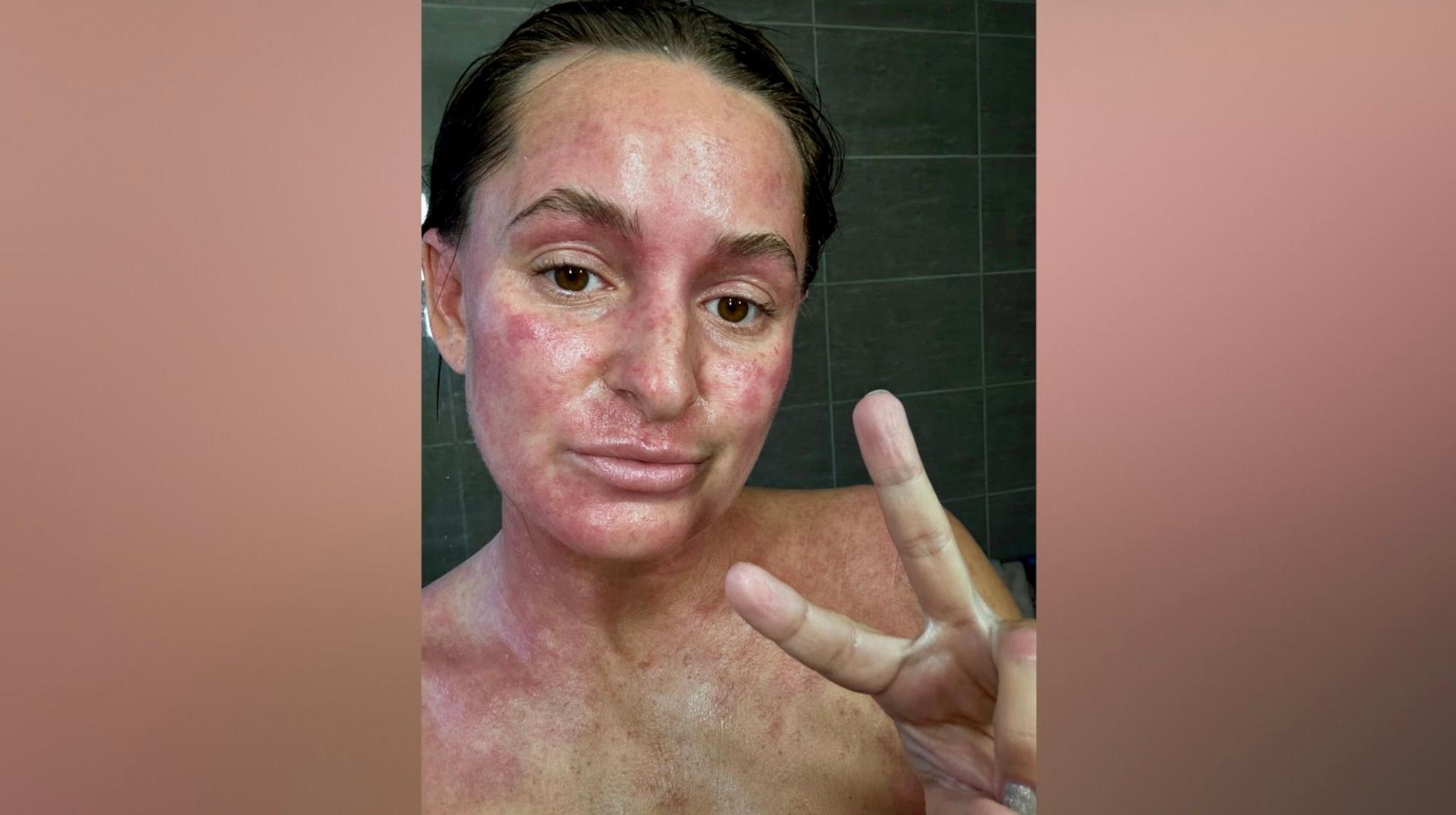 Elise-May's takes a selfie in the shower showing her red skin on her face and neck. She's doing the peace sign with her hand to the camera as well. Her dark hair is wet from the water. The photo is from the shoulders up.