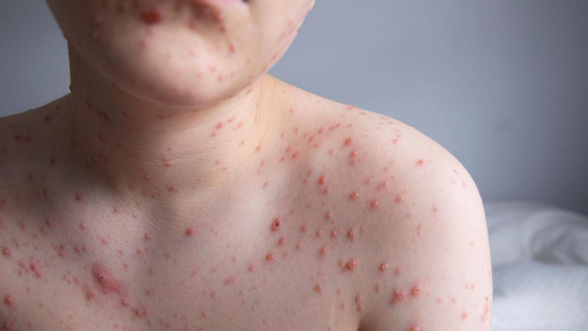 Chickenpox vaccines for children on NHS starts across UK - BBC News