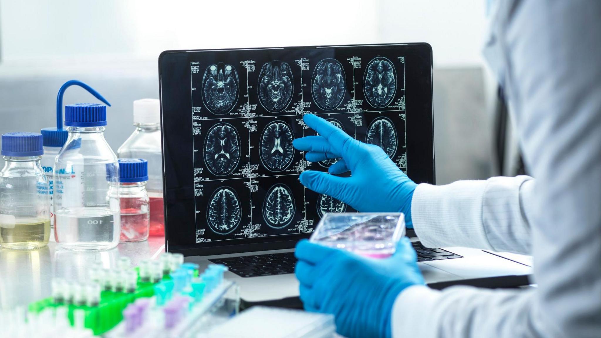 Doctor wearing blue gloves pointing at screen showing scans of someone's brain at different angles.