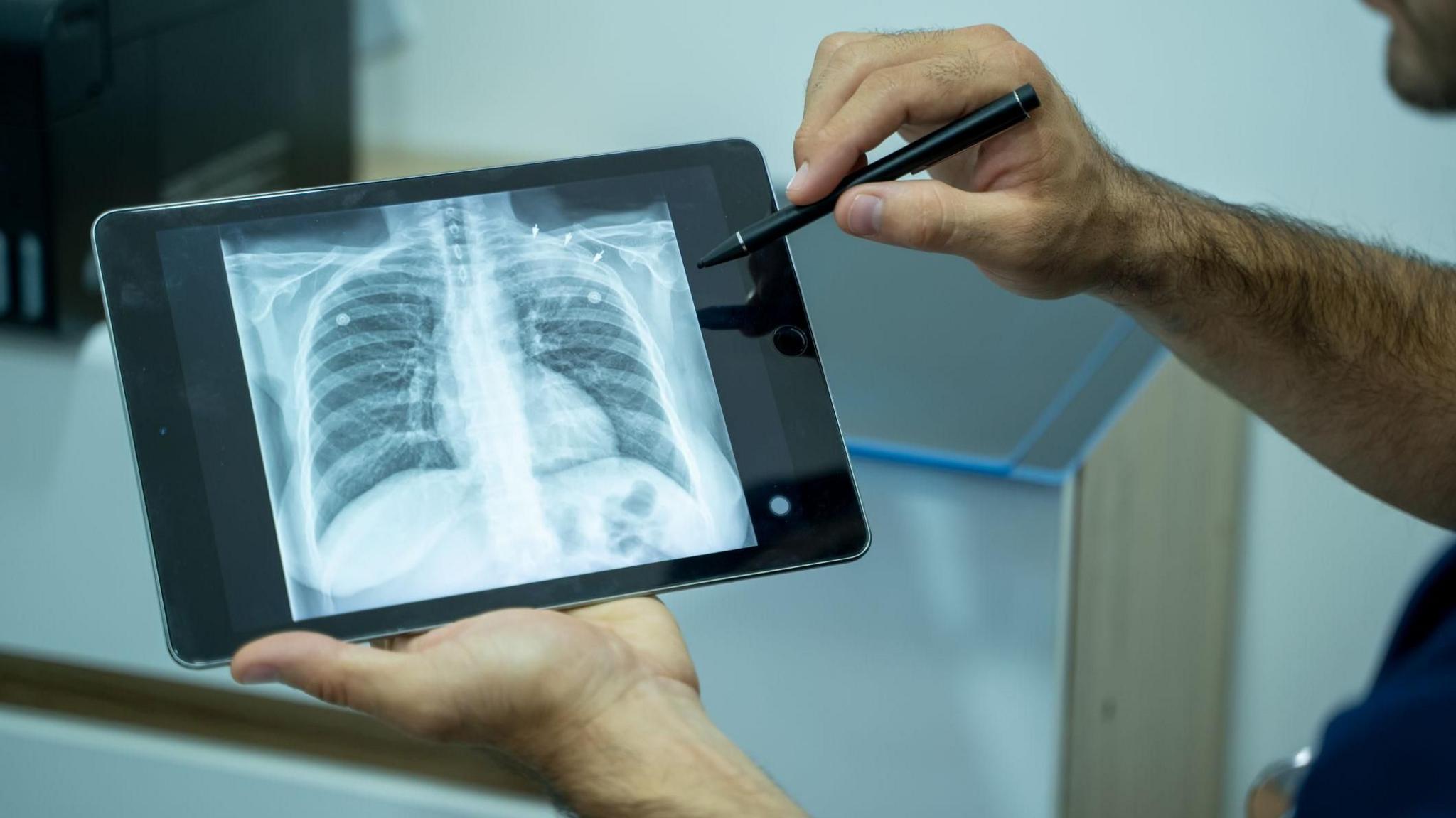 Medical professional holds a tablet showing an X-ray of a pair of lungs