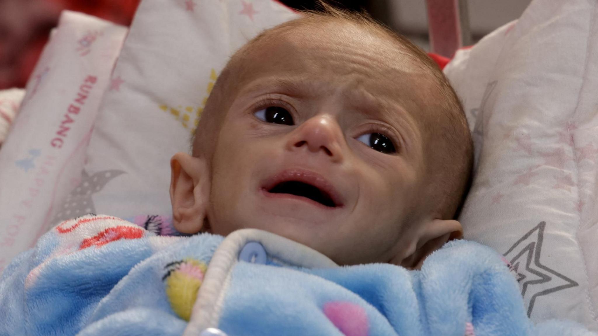A Palestinian girl lies on a bed at Nasser hospital, southern Gaza, where she receives treatment (30 April 2025)