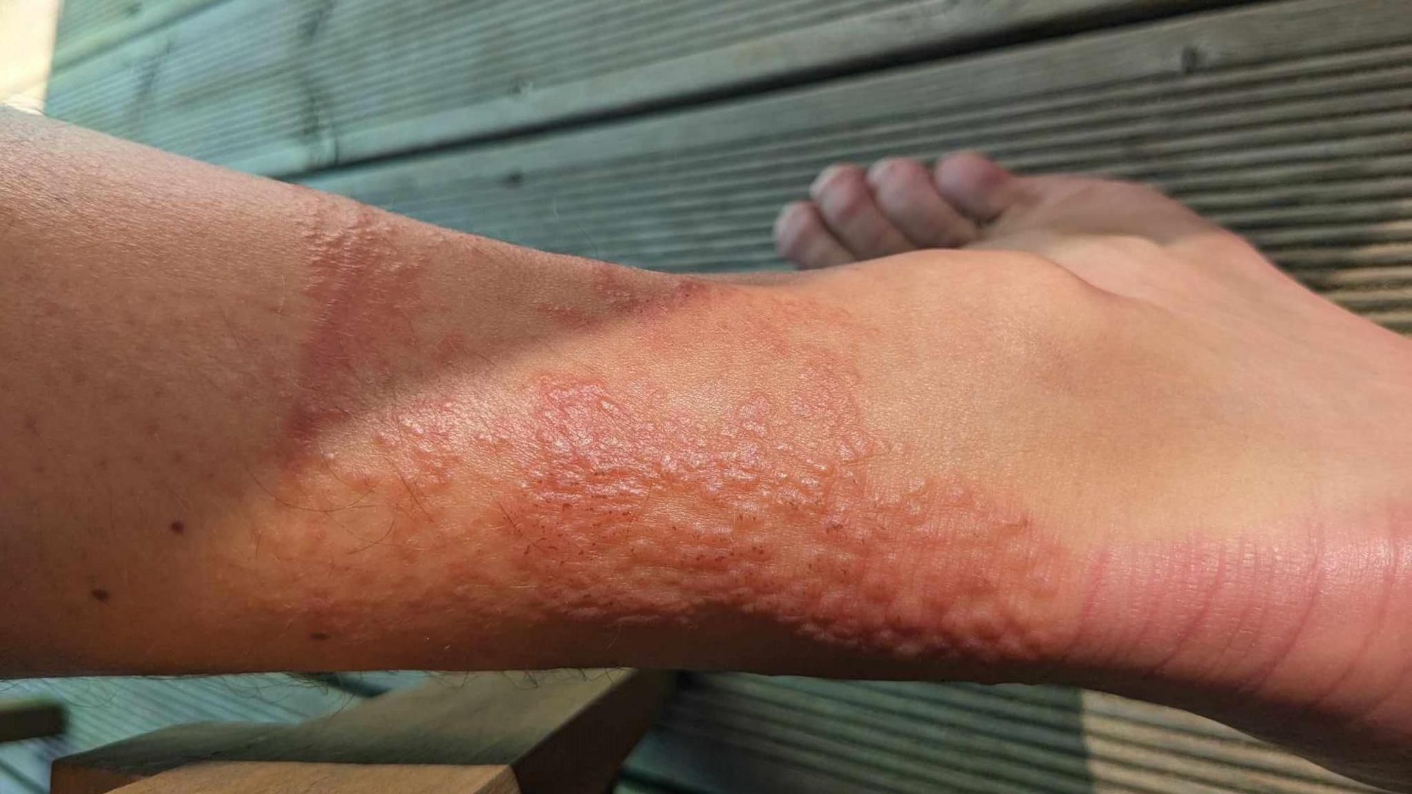 A close-up image shows red bumps on the back of Steve Brindley's right leg following the jellyfish sting. He is standing on wooden decking.