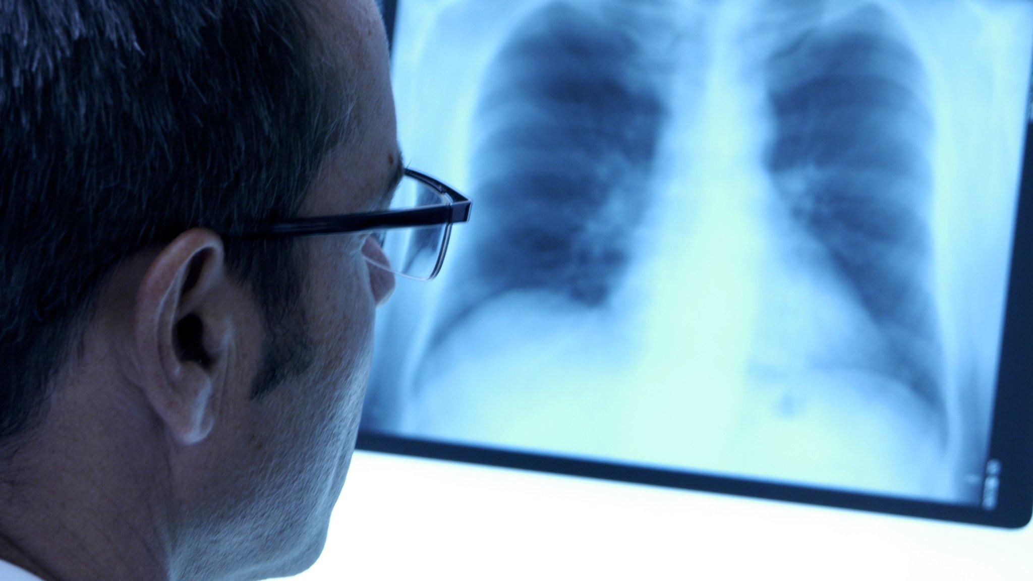 Doctor looking at lung x-ray