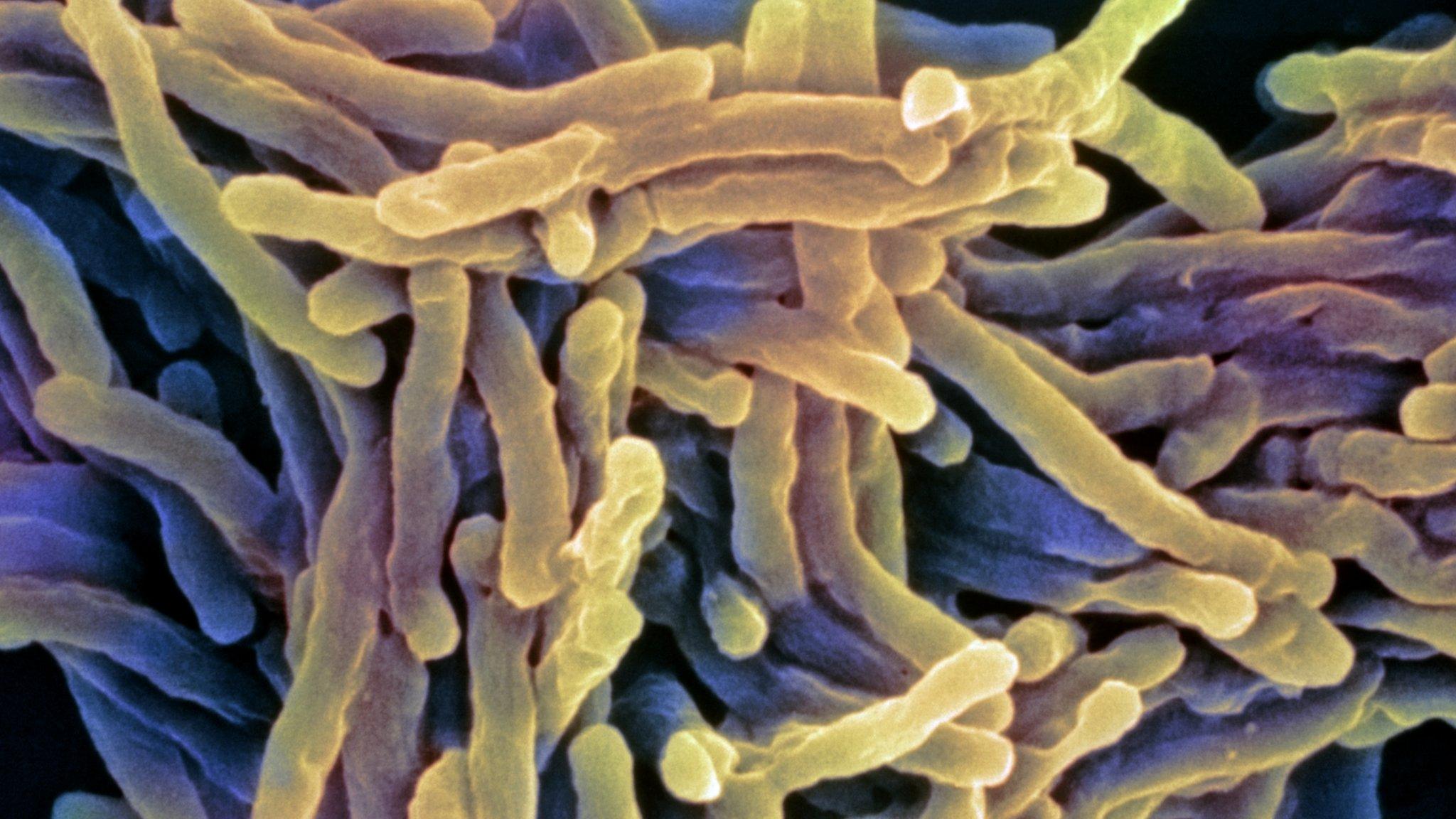 Tuberculosis