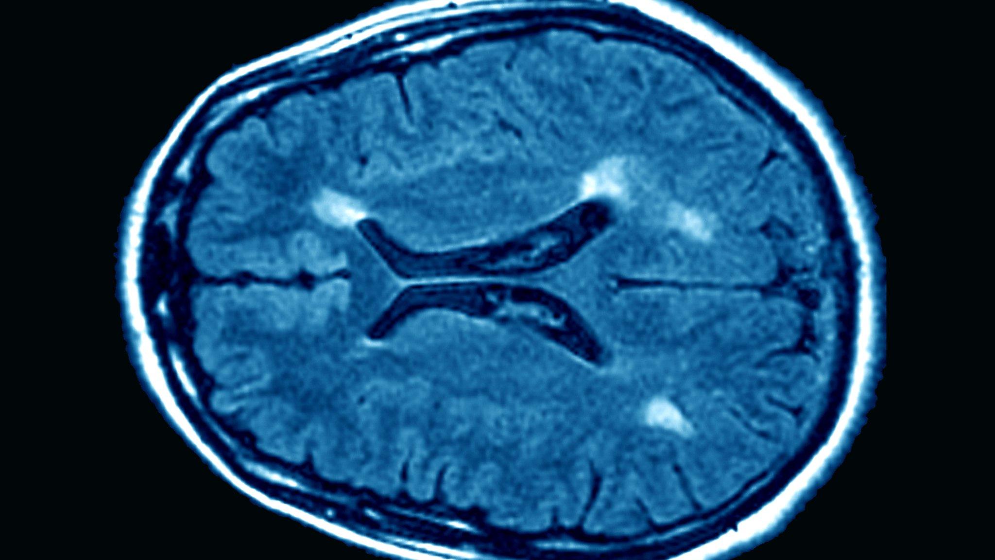 Brain scan