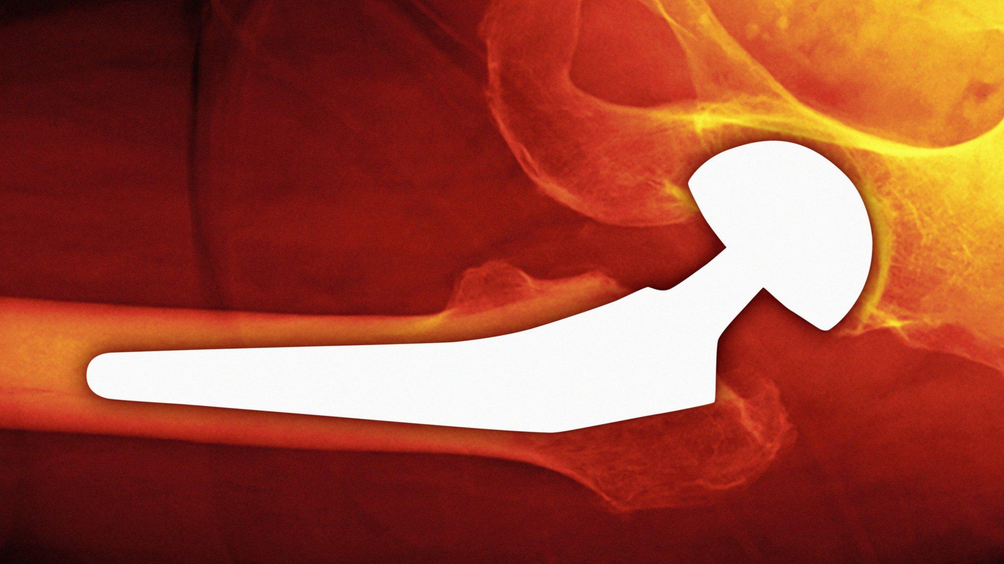 Hip x-ray