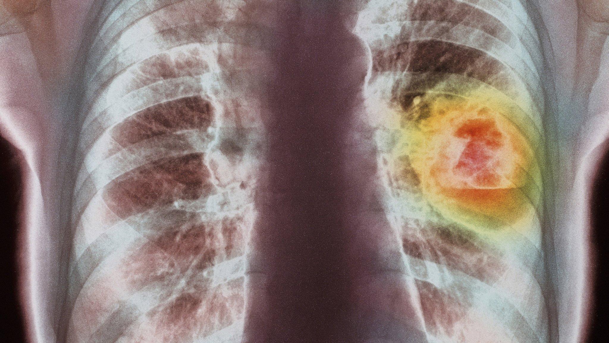 Lung scan showing cancer