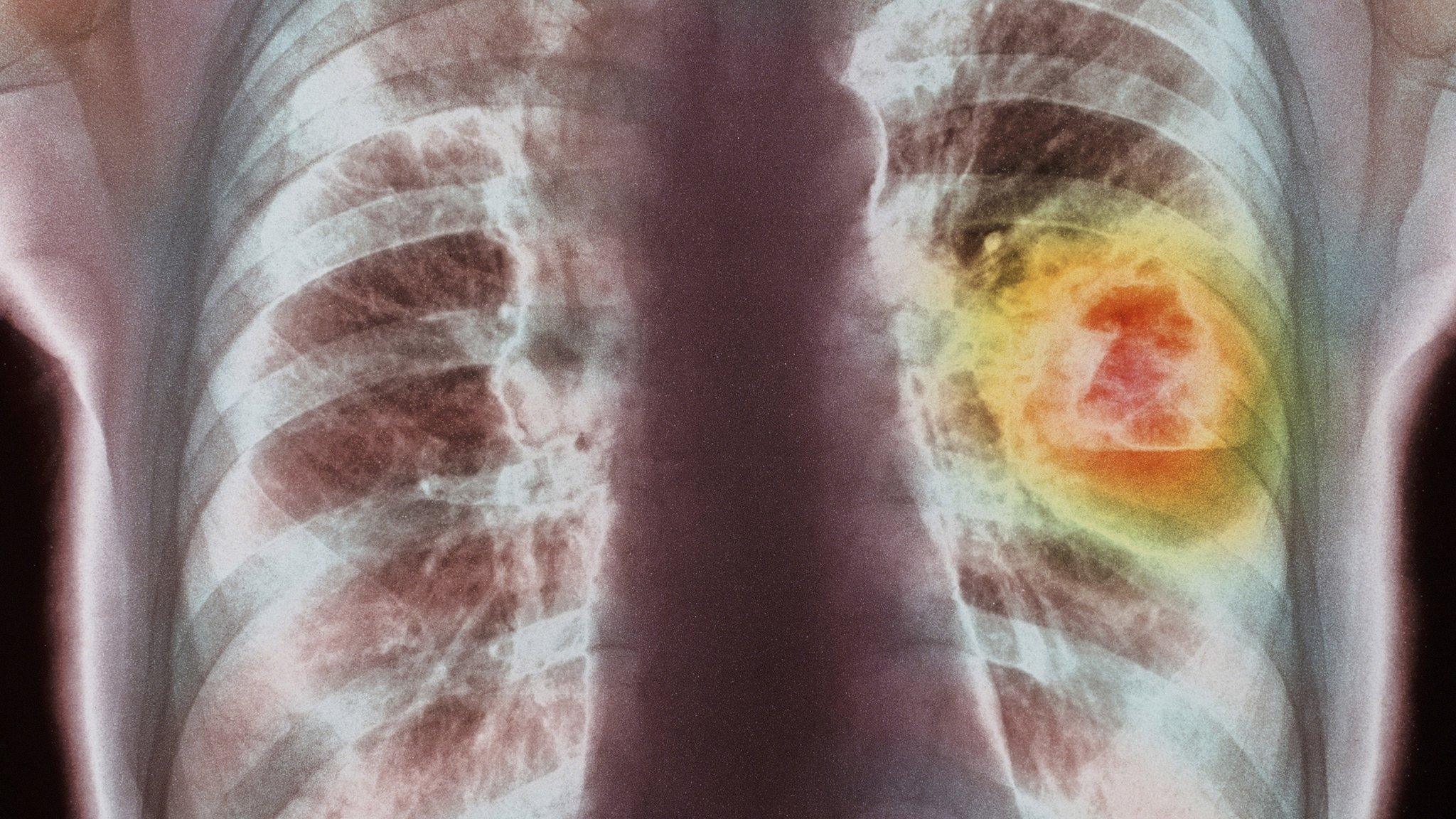 A chest x ray showing lung cancer