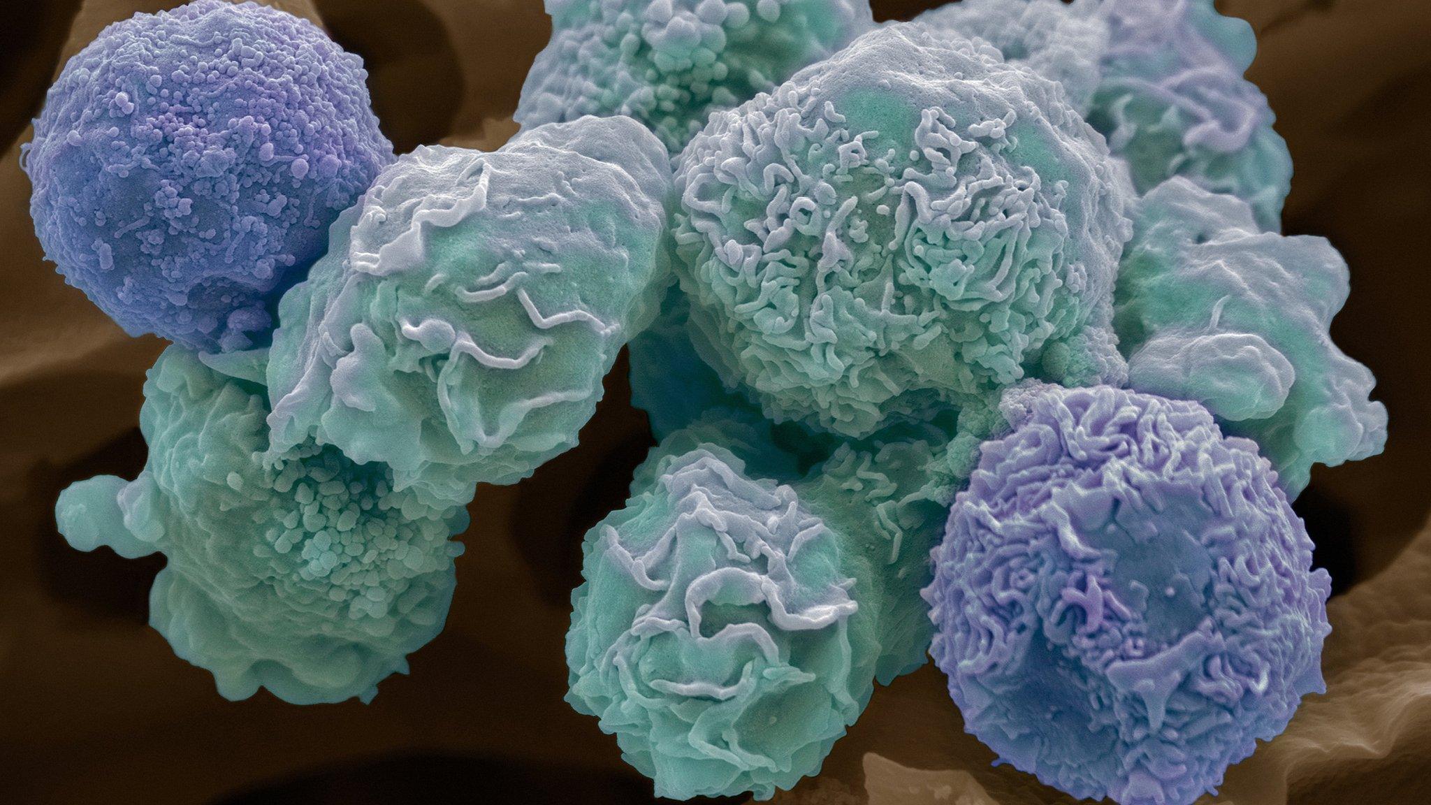 Cervical cancer