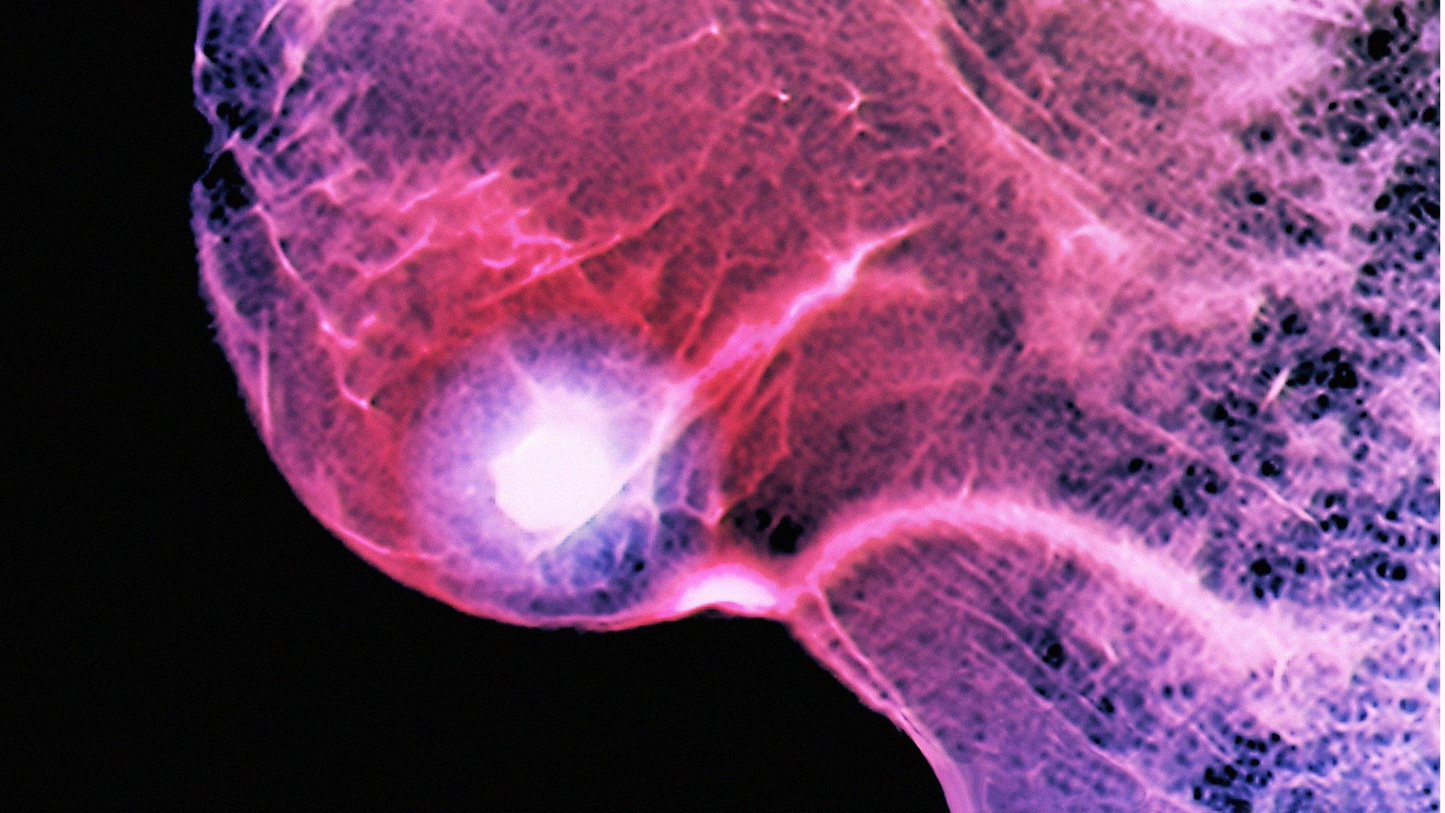 Breast cancer
