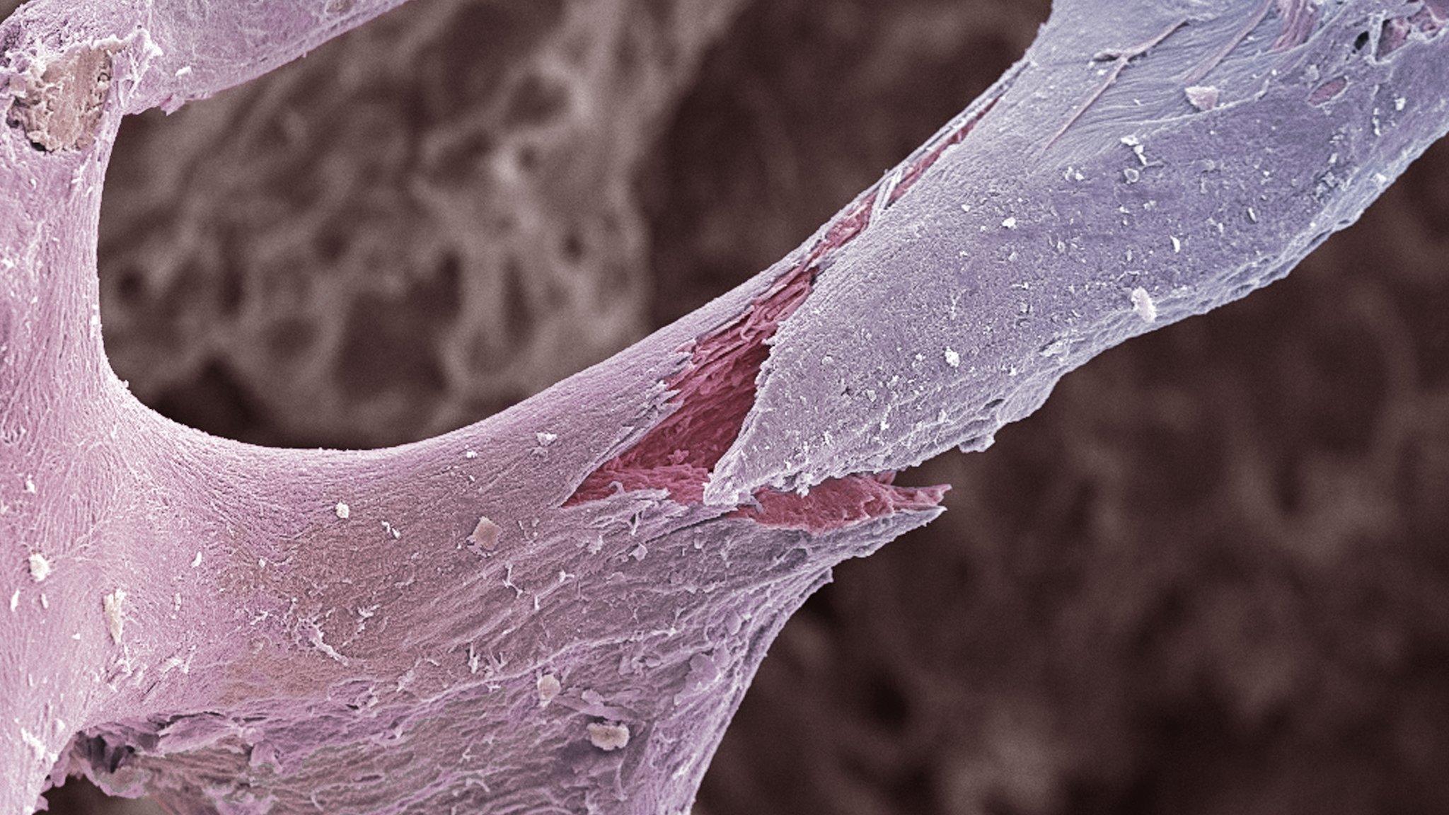 Osteoporotic bone