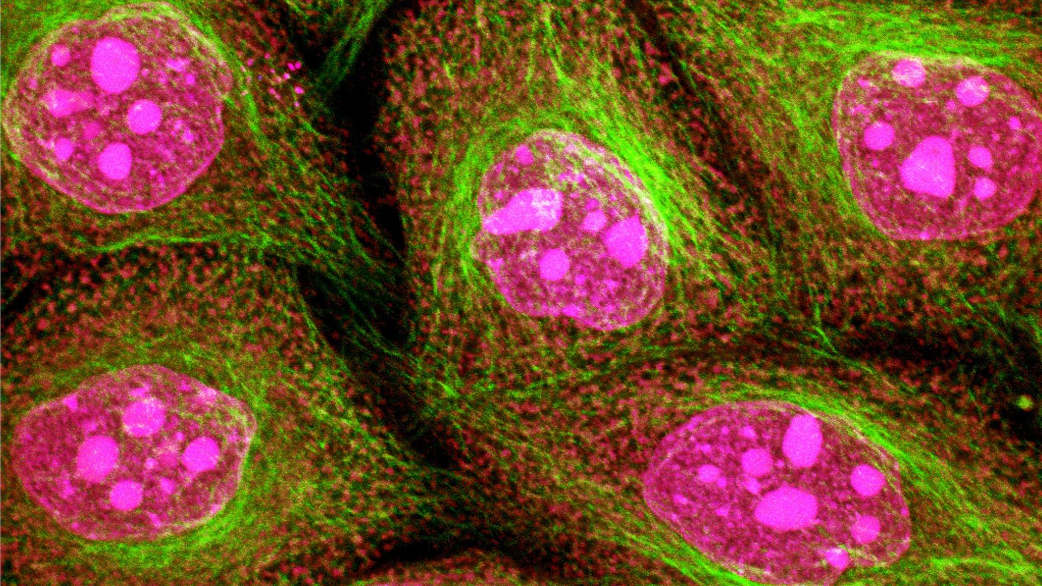 Cervical cancer cells