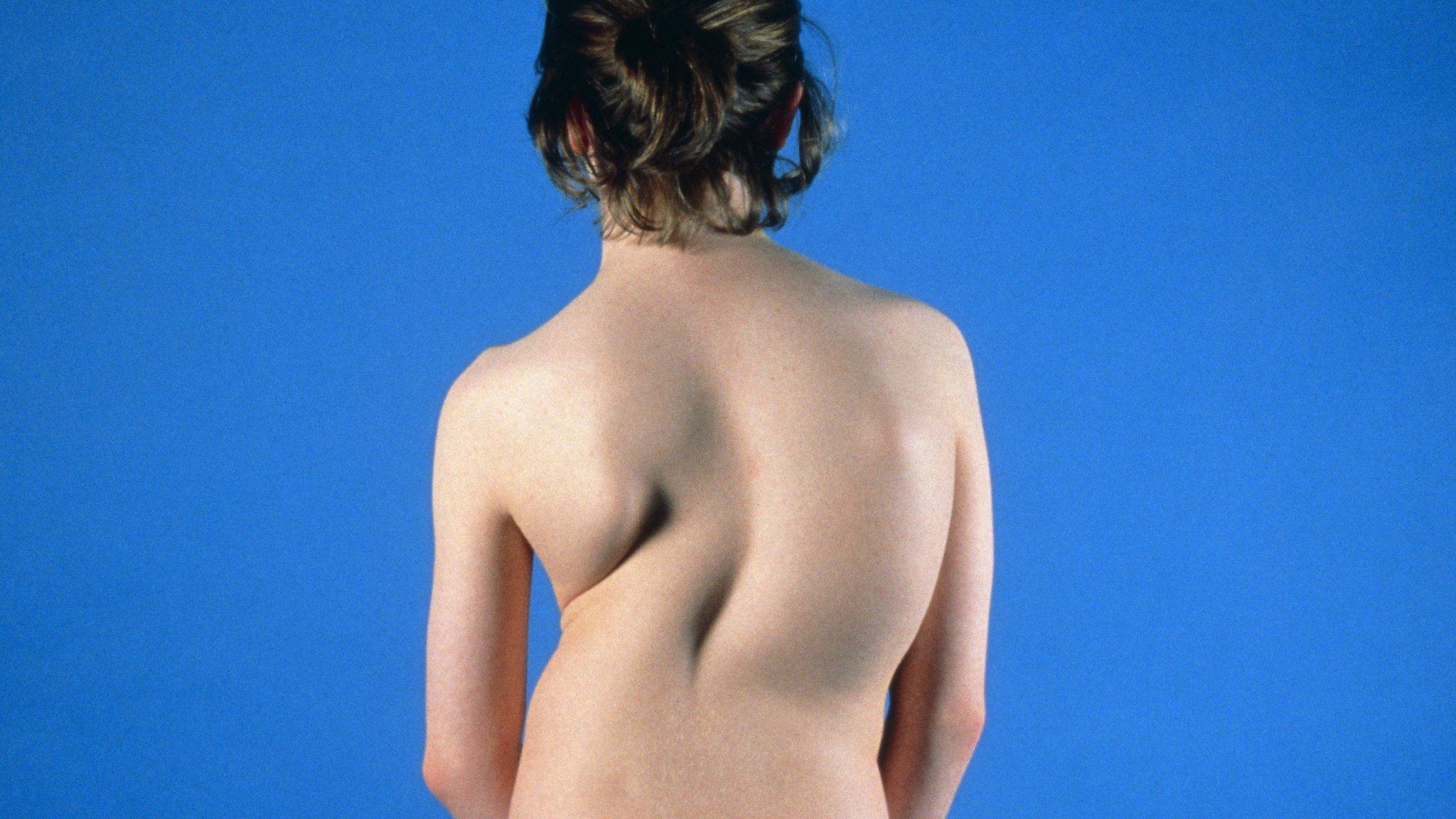 girl with scoliosis