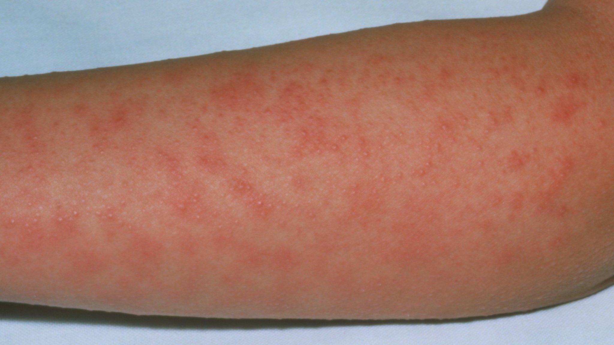 scarlet fever rash
