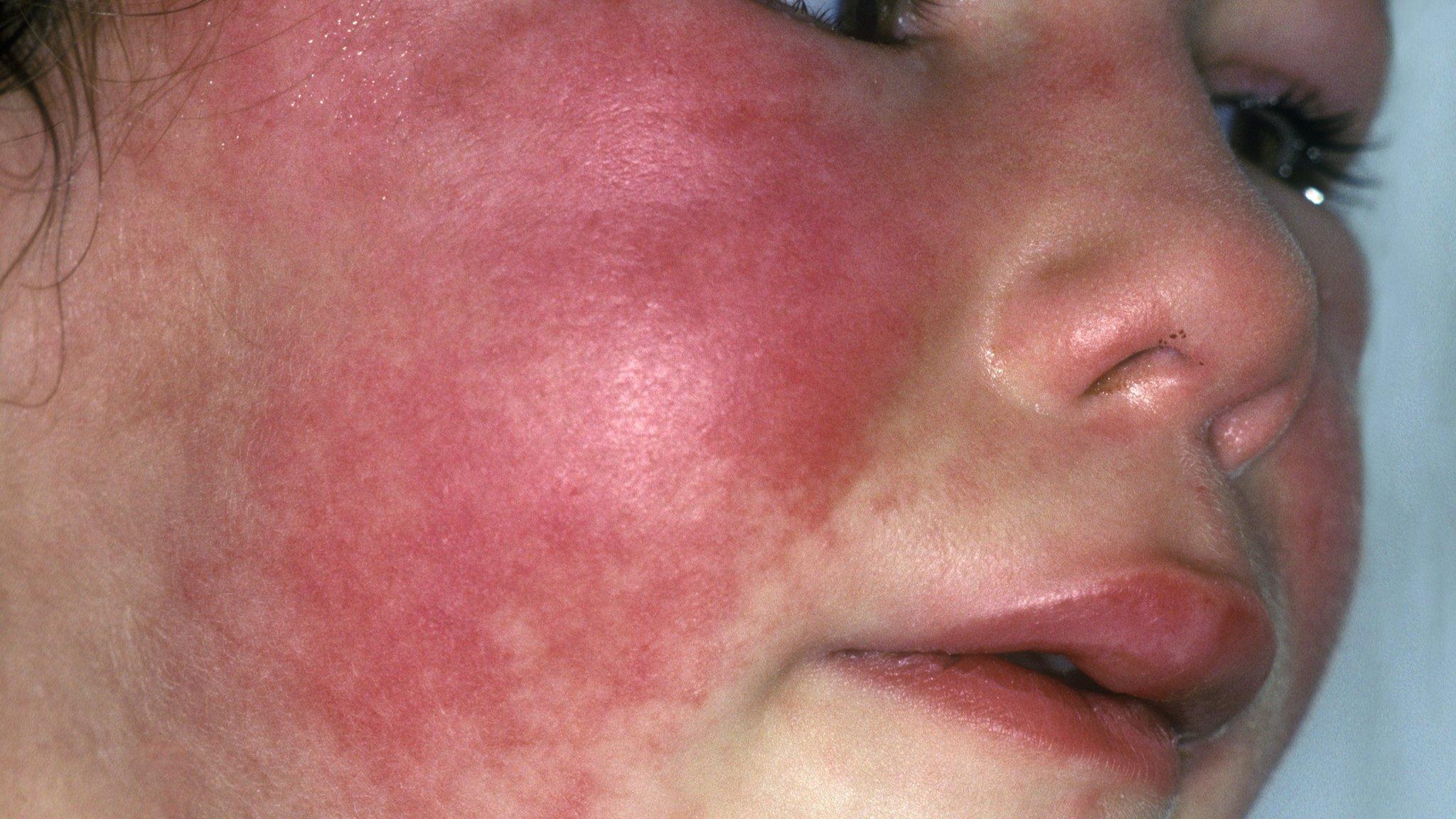 Scarlet fever on child's face