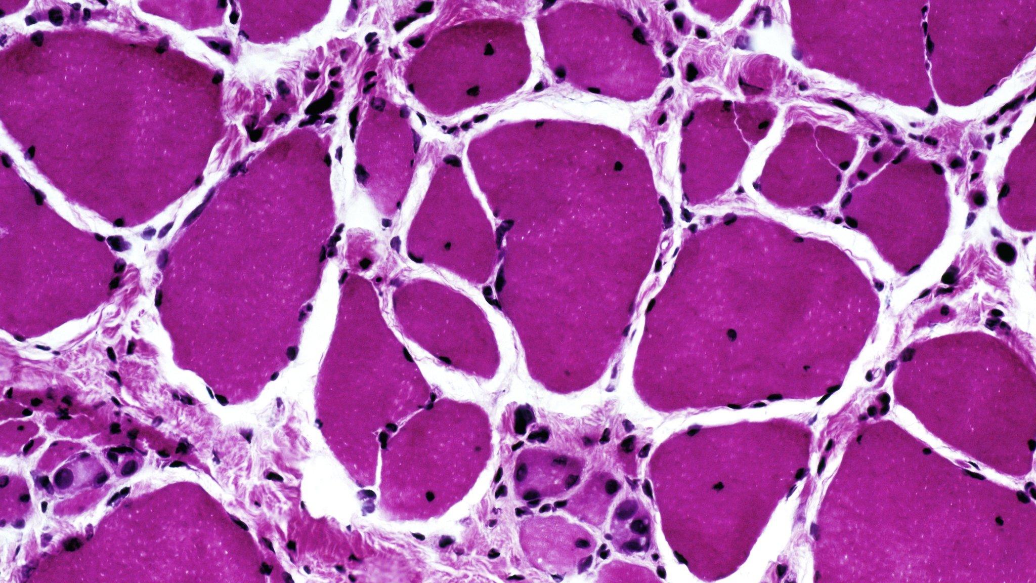 Duchenne muscular dystrophy